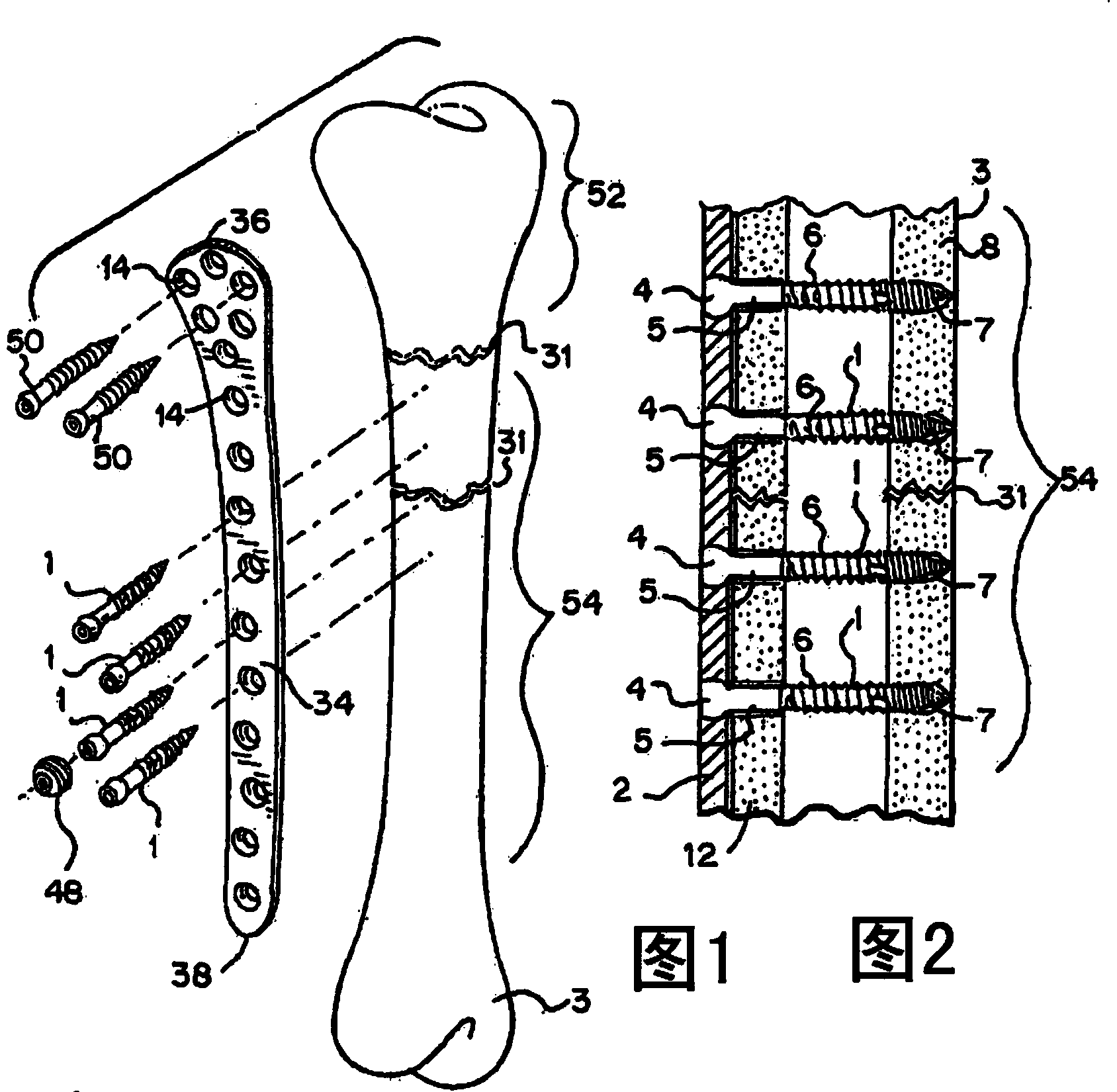 Bone screw with multiple thread profiles for far cortical locking and flexible engagement to a bone