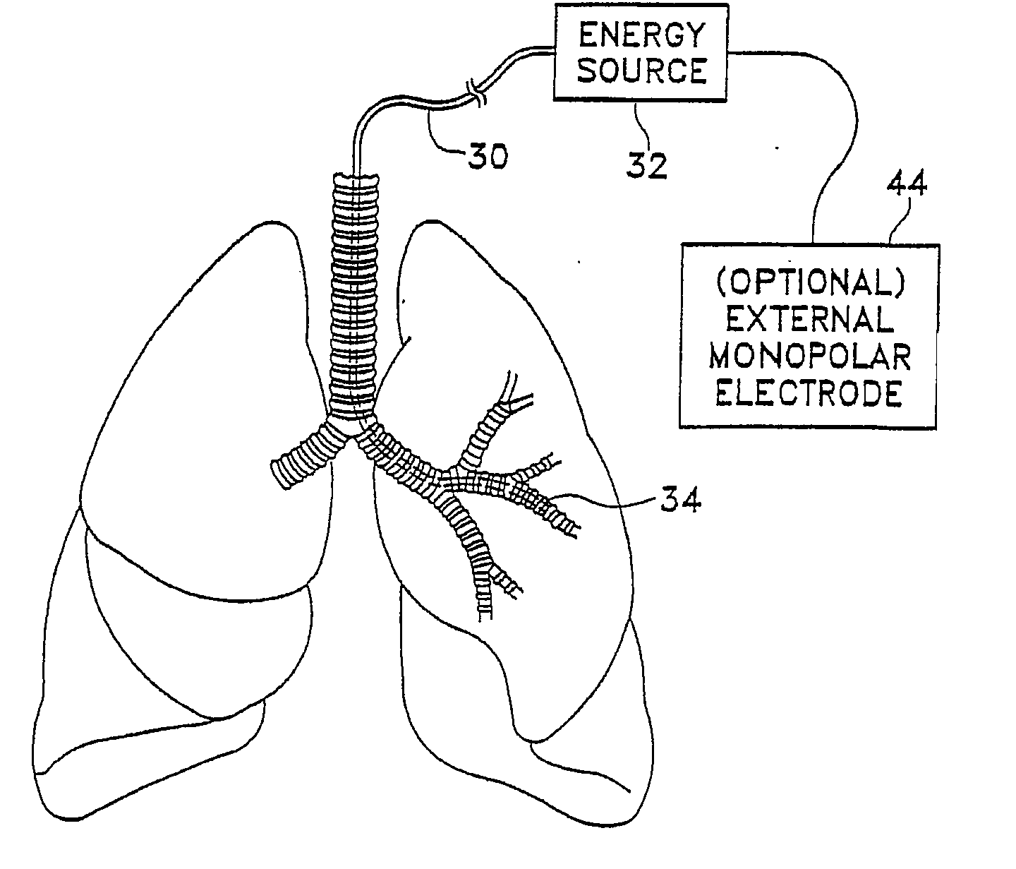 Modification of airways by application of energy