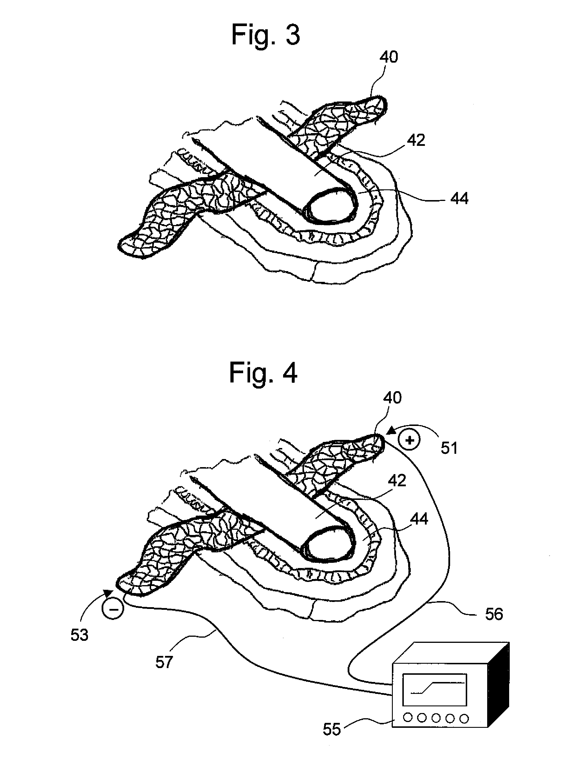 Conductive and degradable implant for pelvic tissue treatment