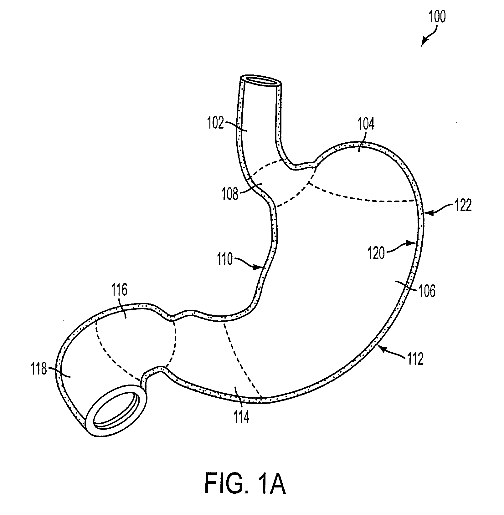 Method and apparatus for gastric restriction of the stomach to treat obesity