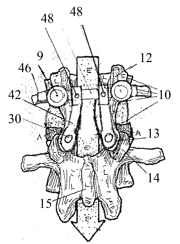 Posterior-medial facet support assembly