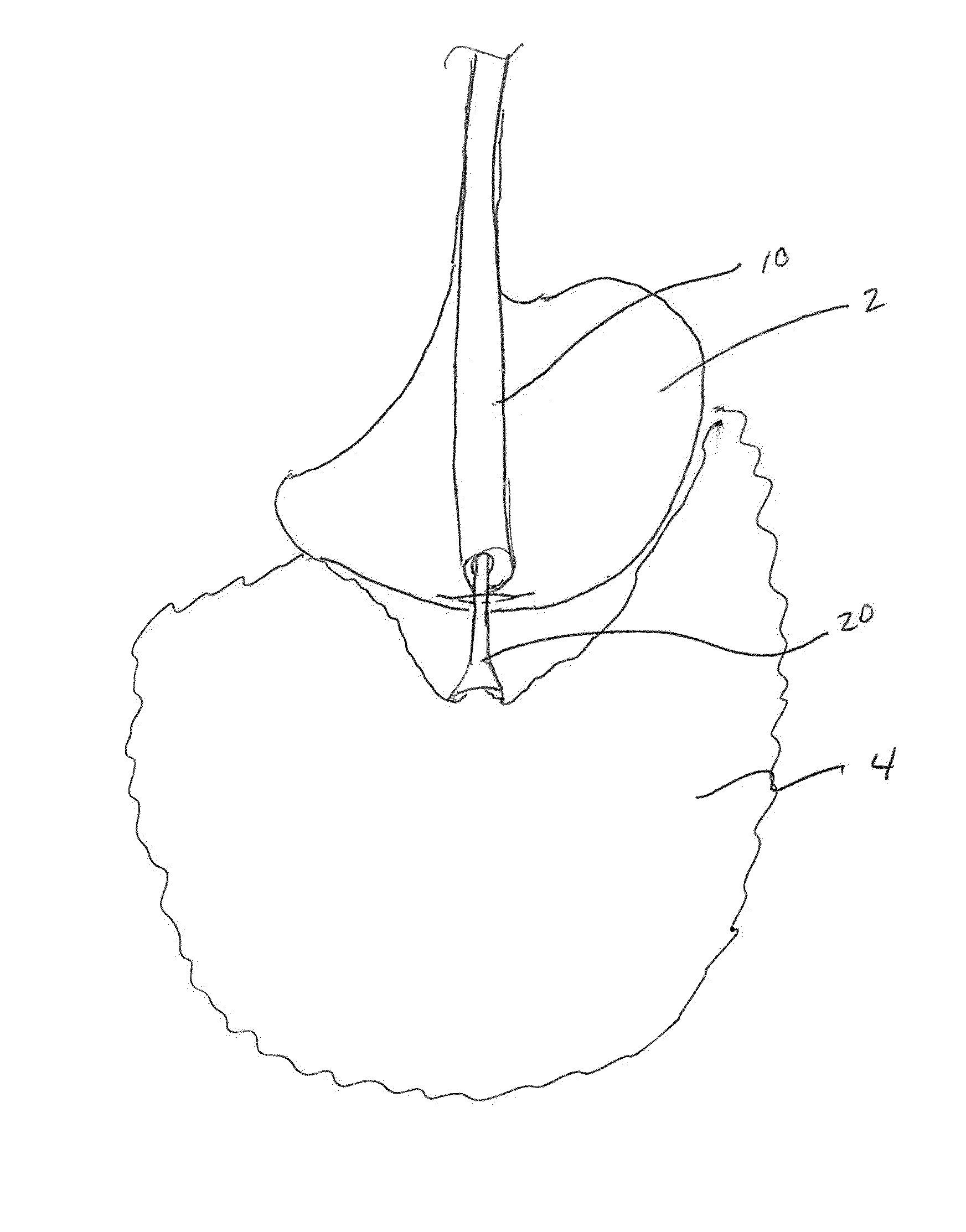 Methods and devices for removing omental tissue