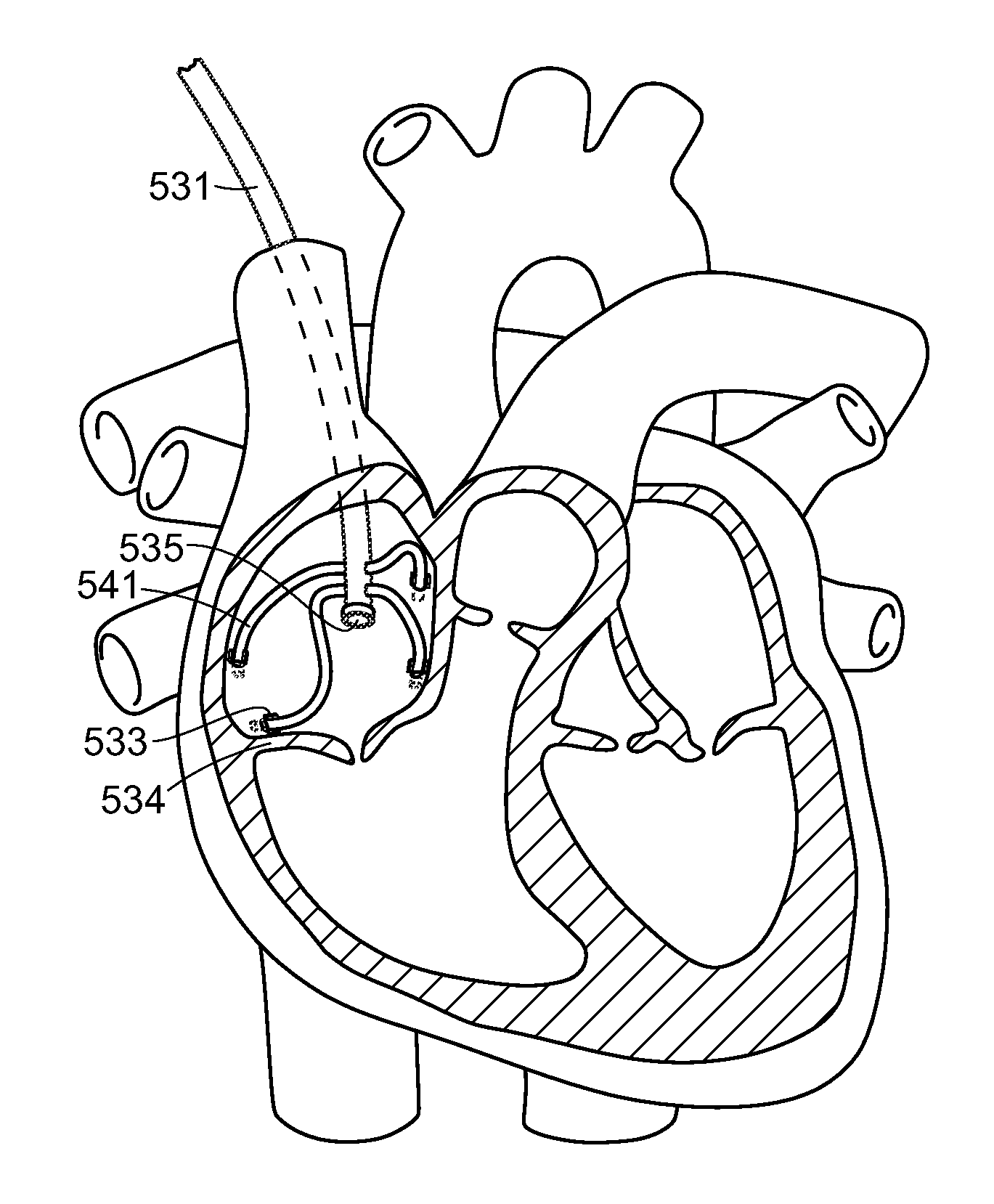 Catheter systems and related methods for mapping, minimizing, and treating cardiac fibrillation