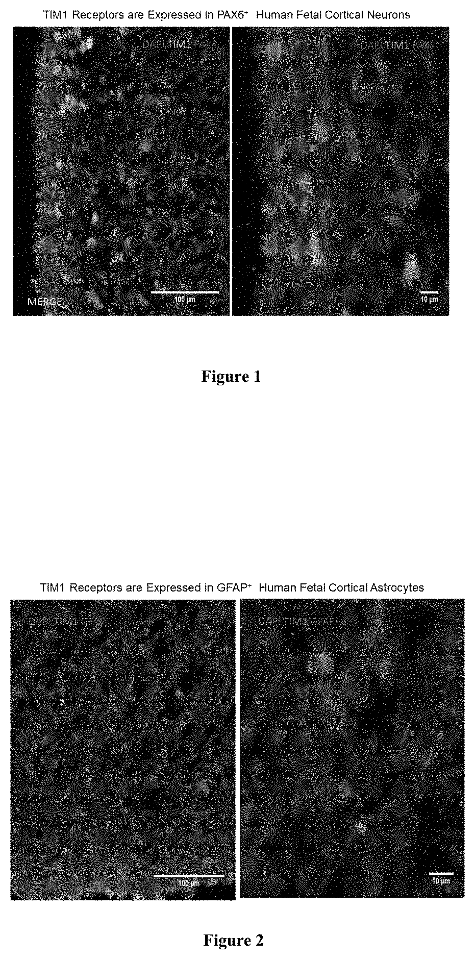 Methods and compositions for treating glioma and medulloblastoma brain tumors using the zika virus