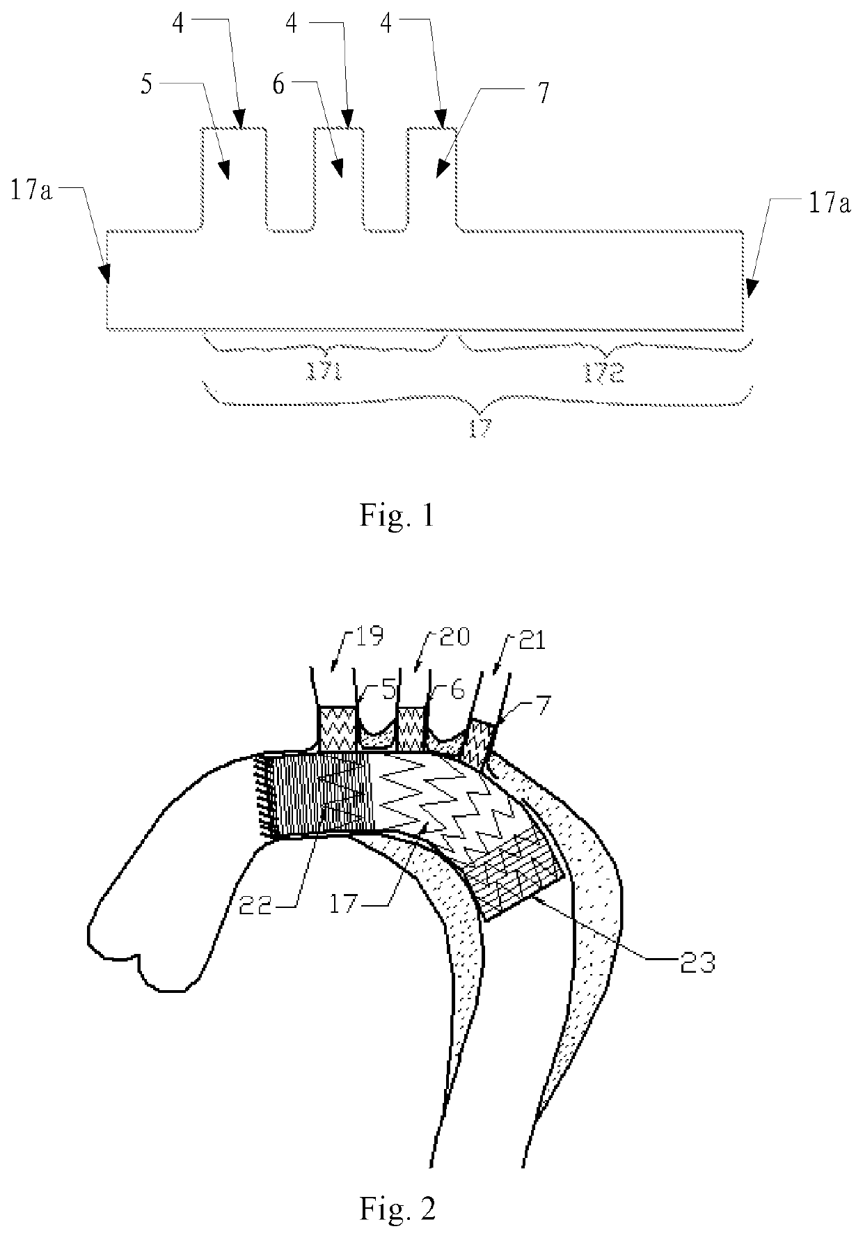 Aortic arch intraoperative stent and manufacturing method thereof