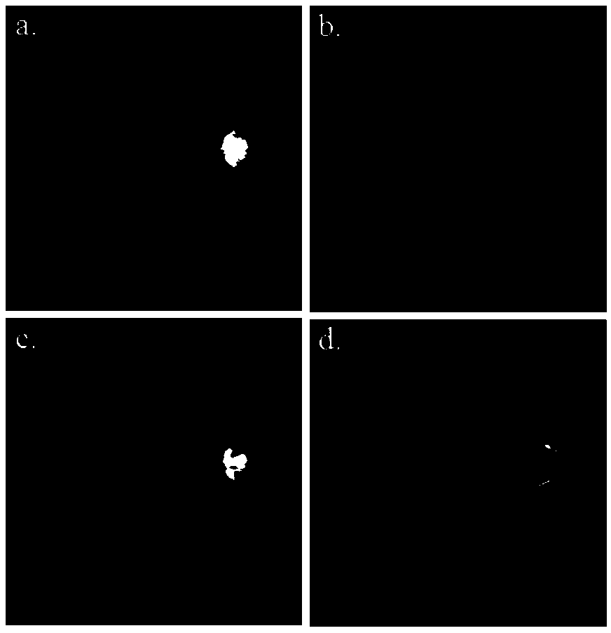 Automatic retinal blood vessel segmentation for clinical diagnosis of glaucoma