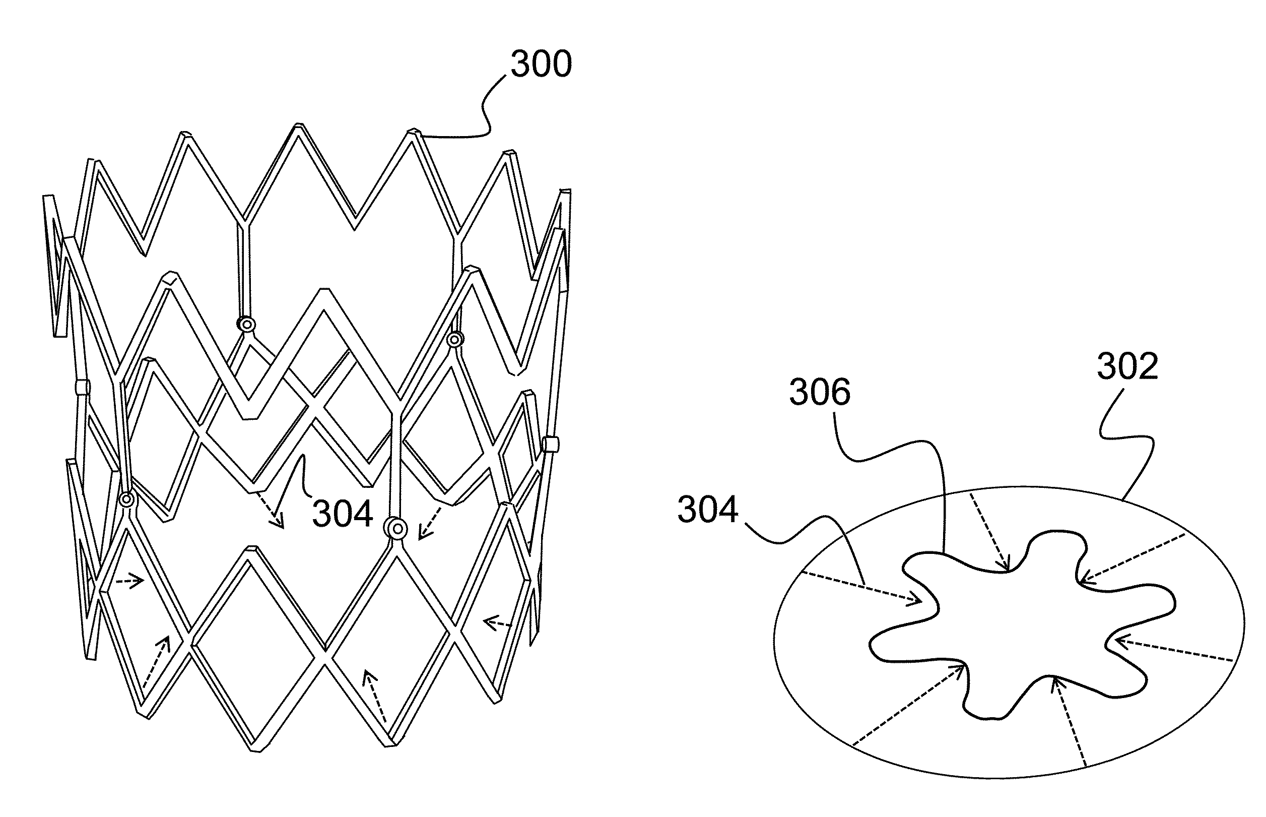 Expandable stent that collapses into a non-convex shape and expands into an expanded, convex shape