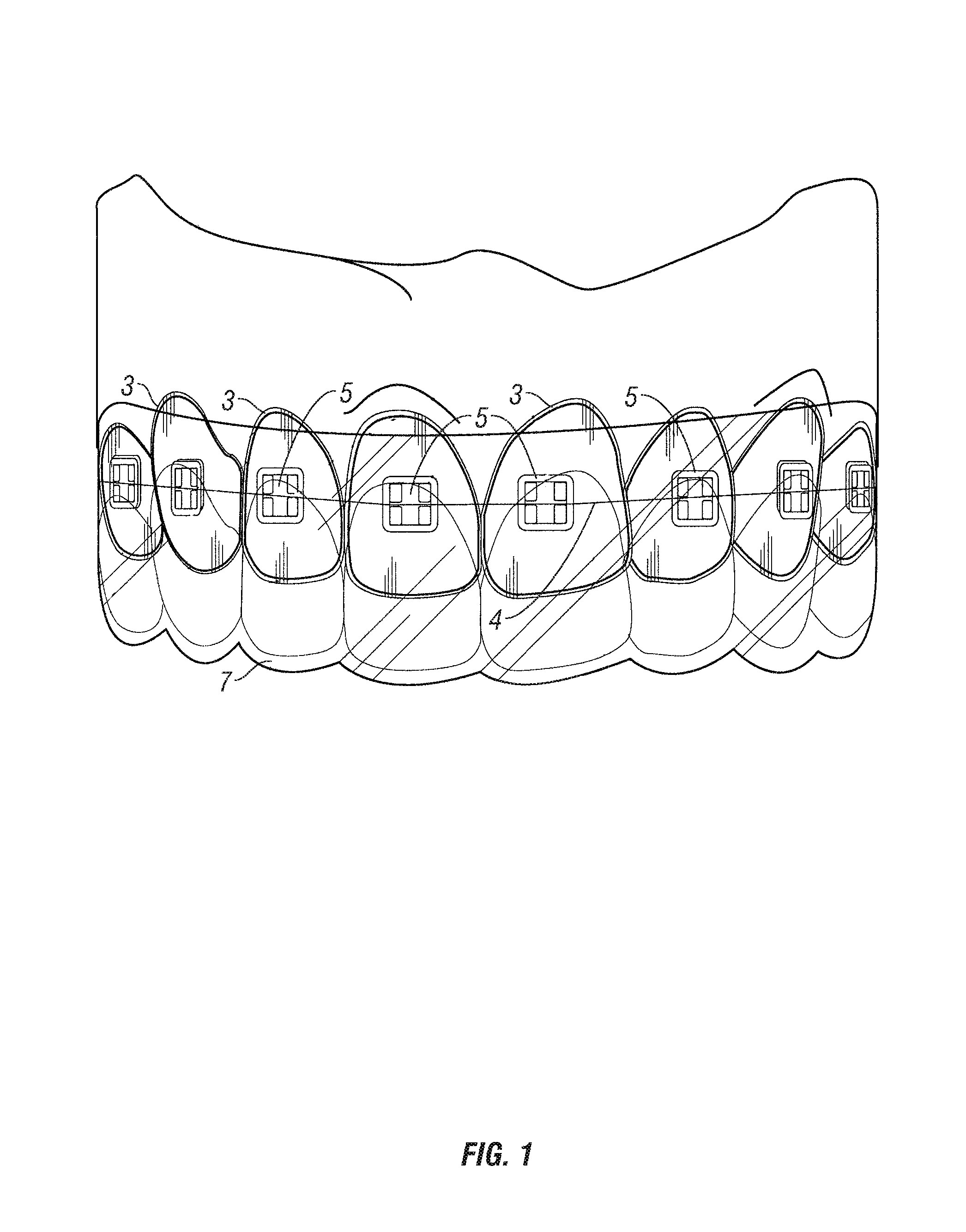 Orthodontic appliance system