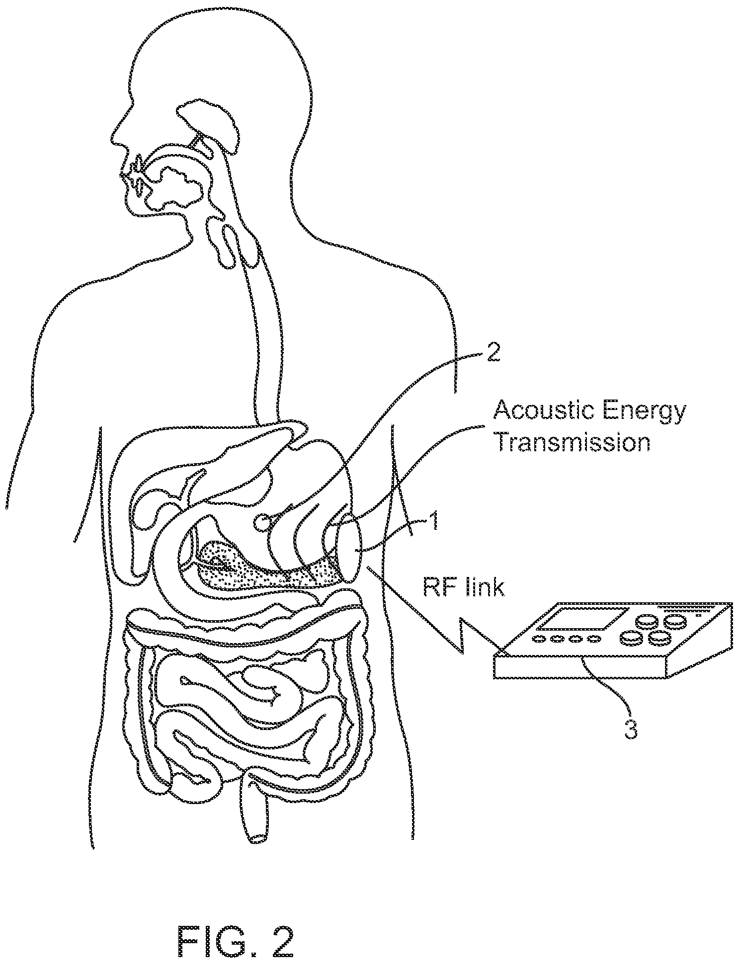 Systems and methods for implantable leadless gastrointestinal tissue stimulation