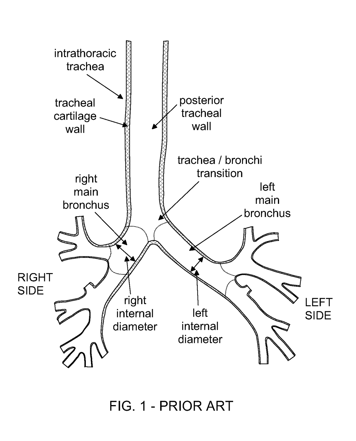 Dual Lumen Endobronchial Tube Device