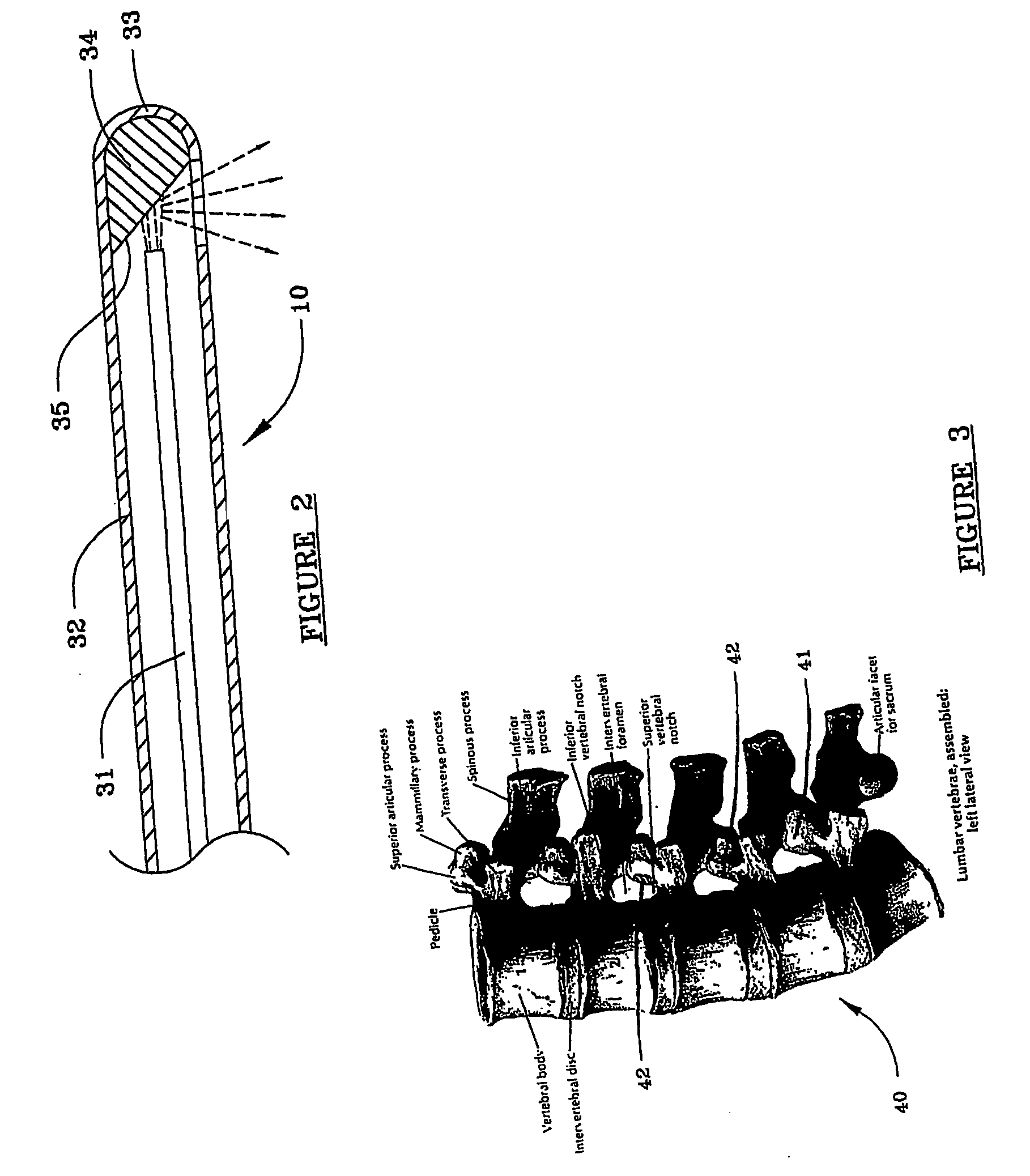 Devices and methods for minimally invasive treatment of degenerated spinal discs