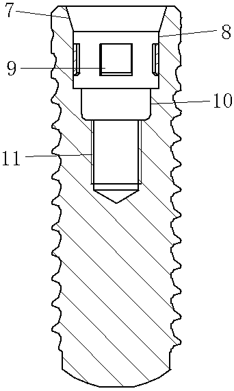 Artificial dental implant