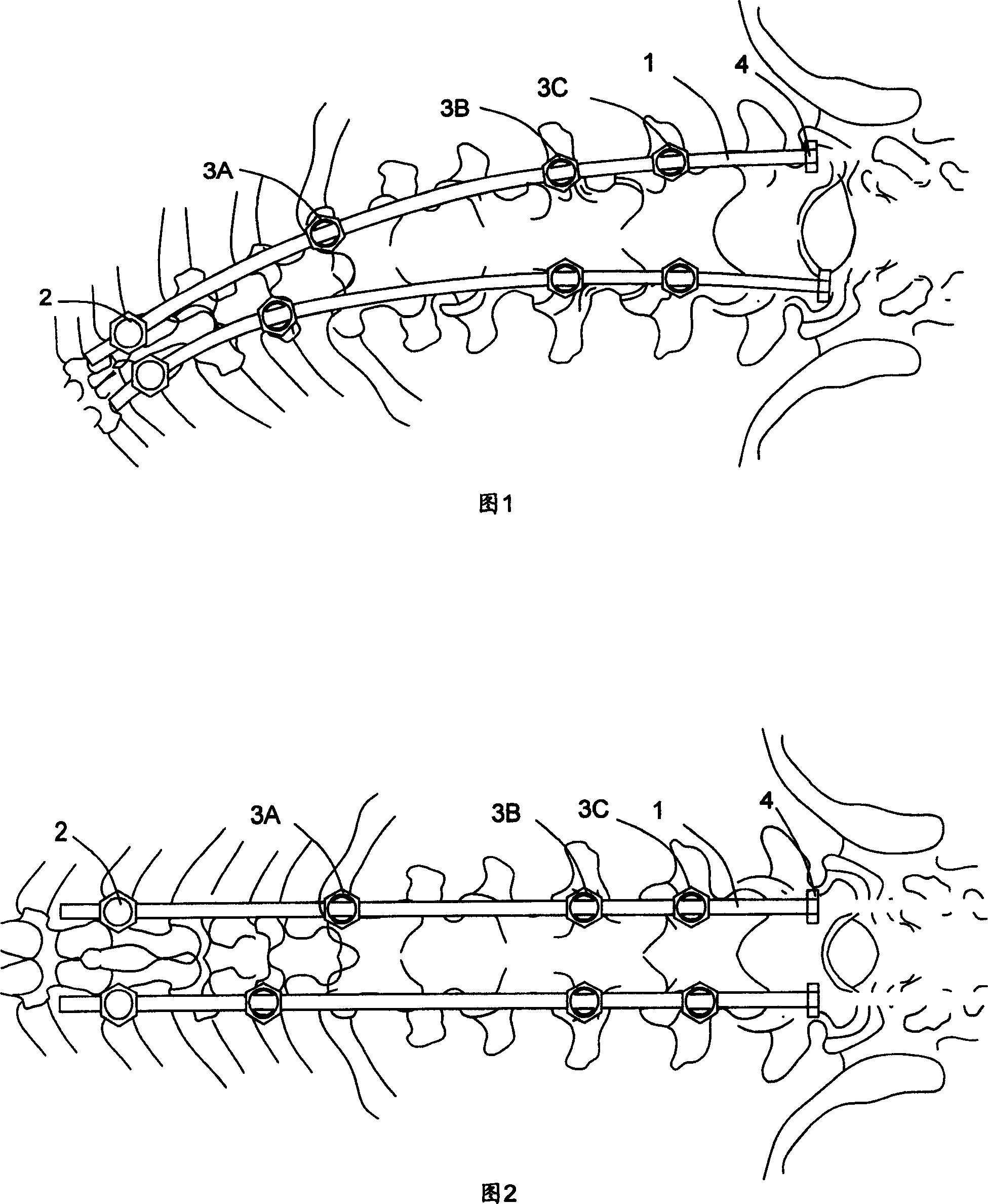 Non-blending spinal side bending corrector