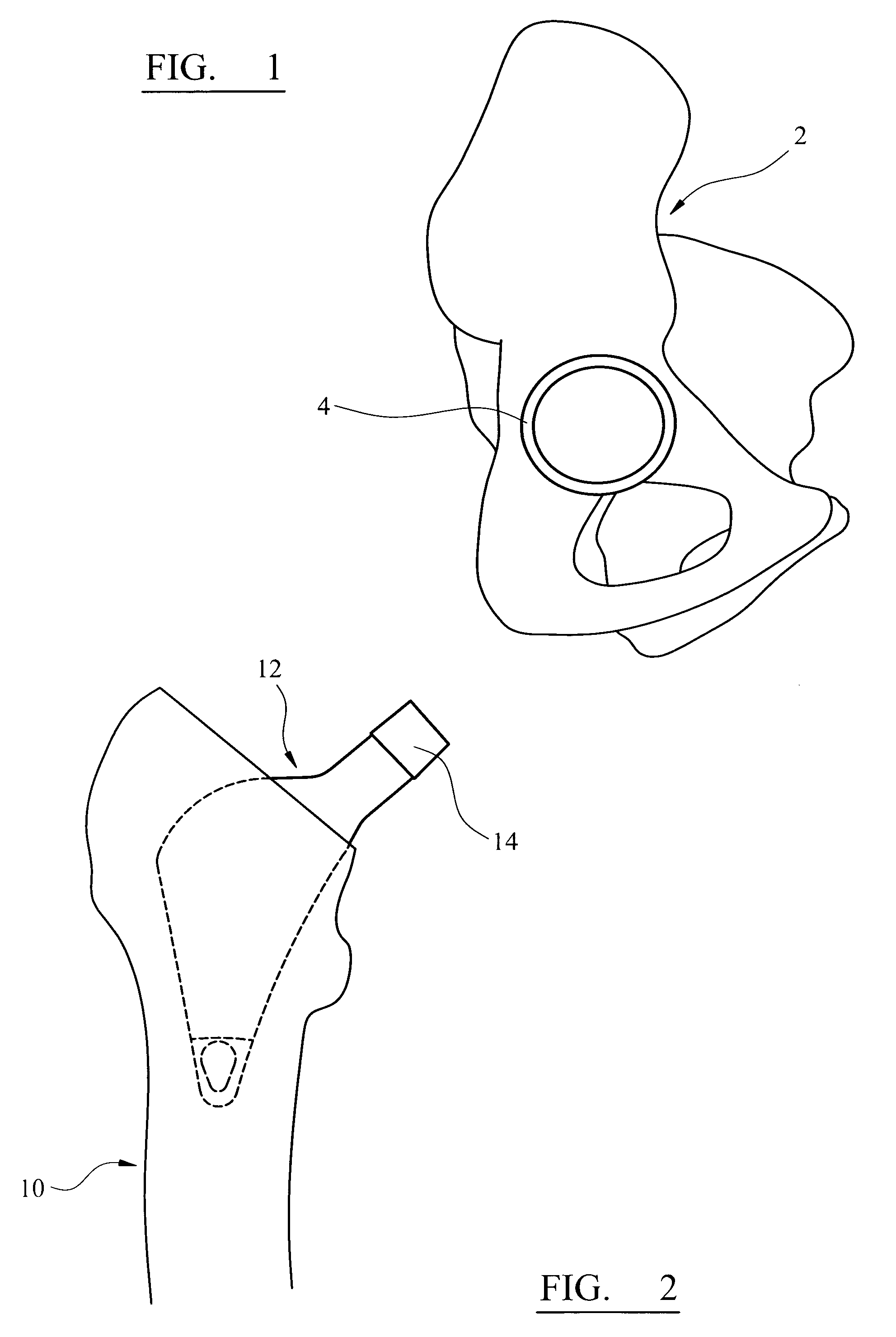 Instrument for use in a joint replacement procedure