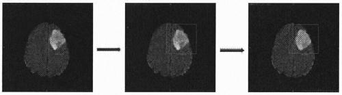 Brain glioma segmentation based on cascaded convolutional neural network