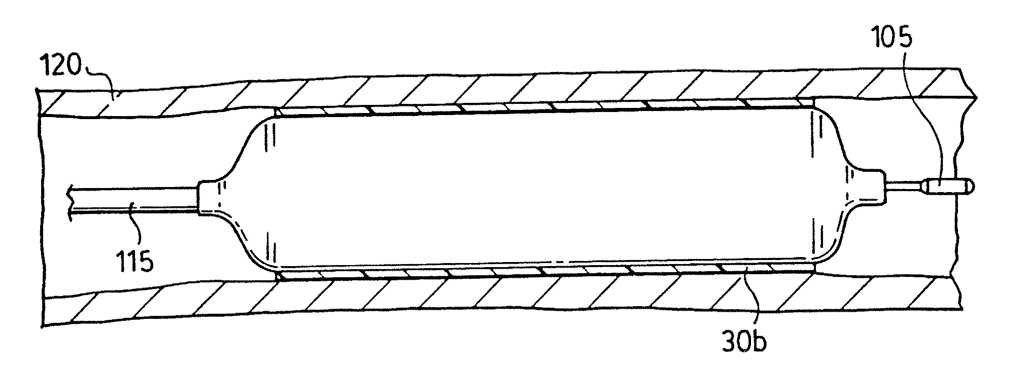 Small vessel expandable stent and method for production of same