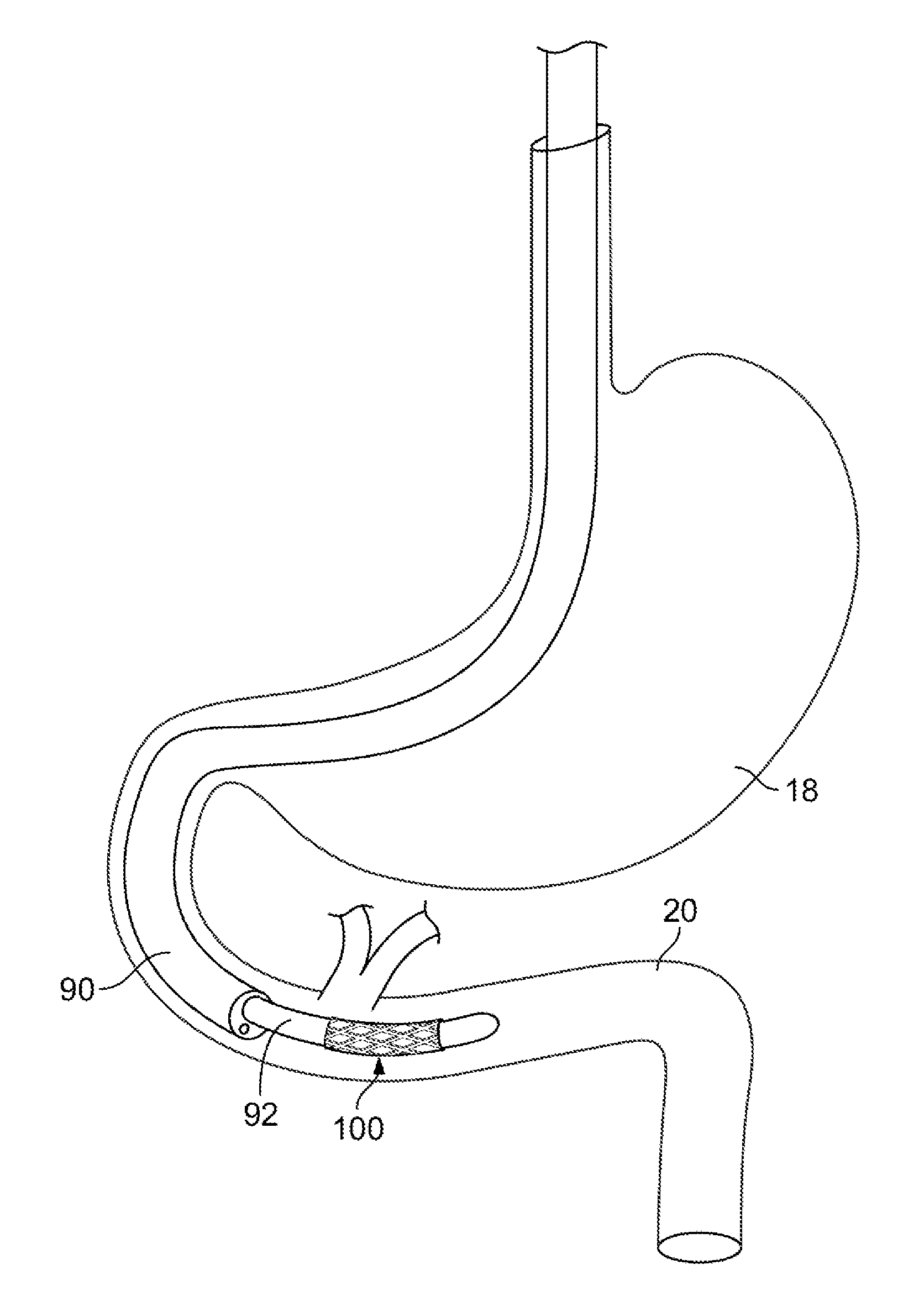 Gastrointestinal implant and methods for use