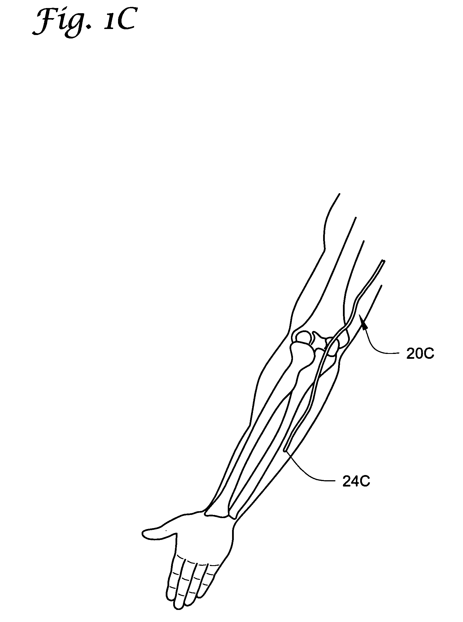 Catheters with tracking elements and permeable membranes