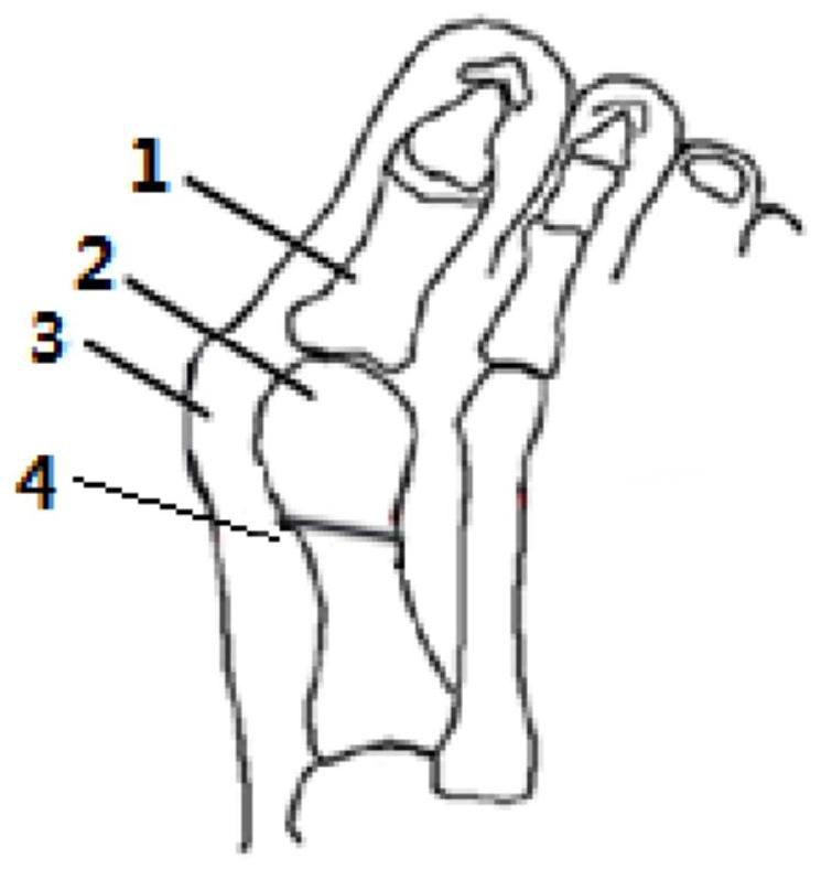 A fixation device after distal metatarsal osteotomy