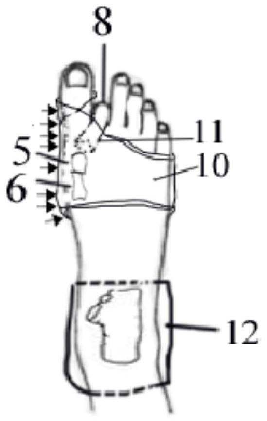 A fixation device after distal metatarsal osteotomy