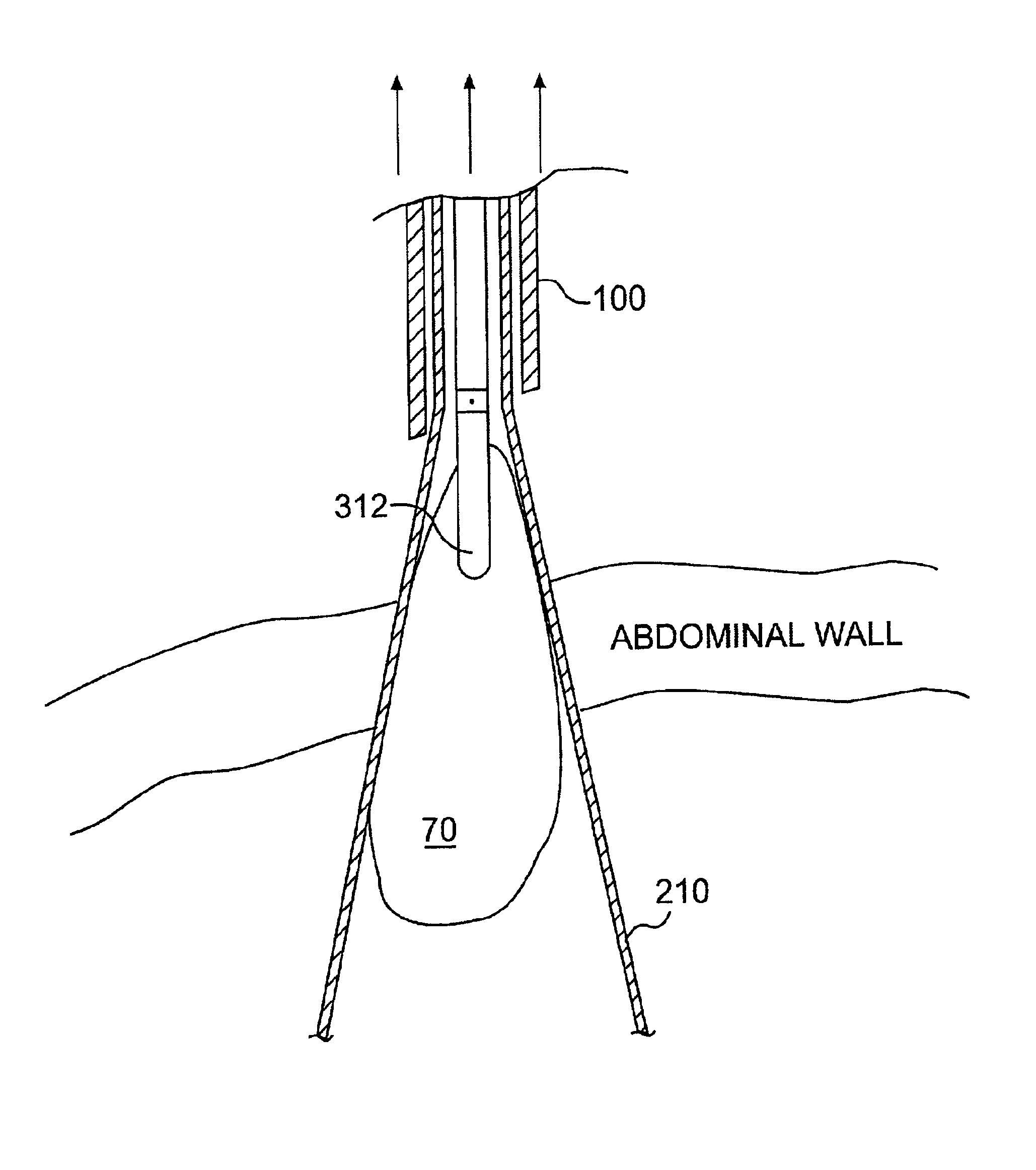 Instruments and methods for use in laparoscopic surgery
