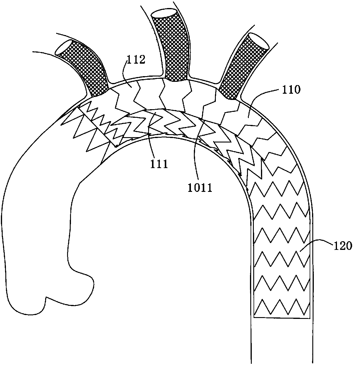 Covered stent