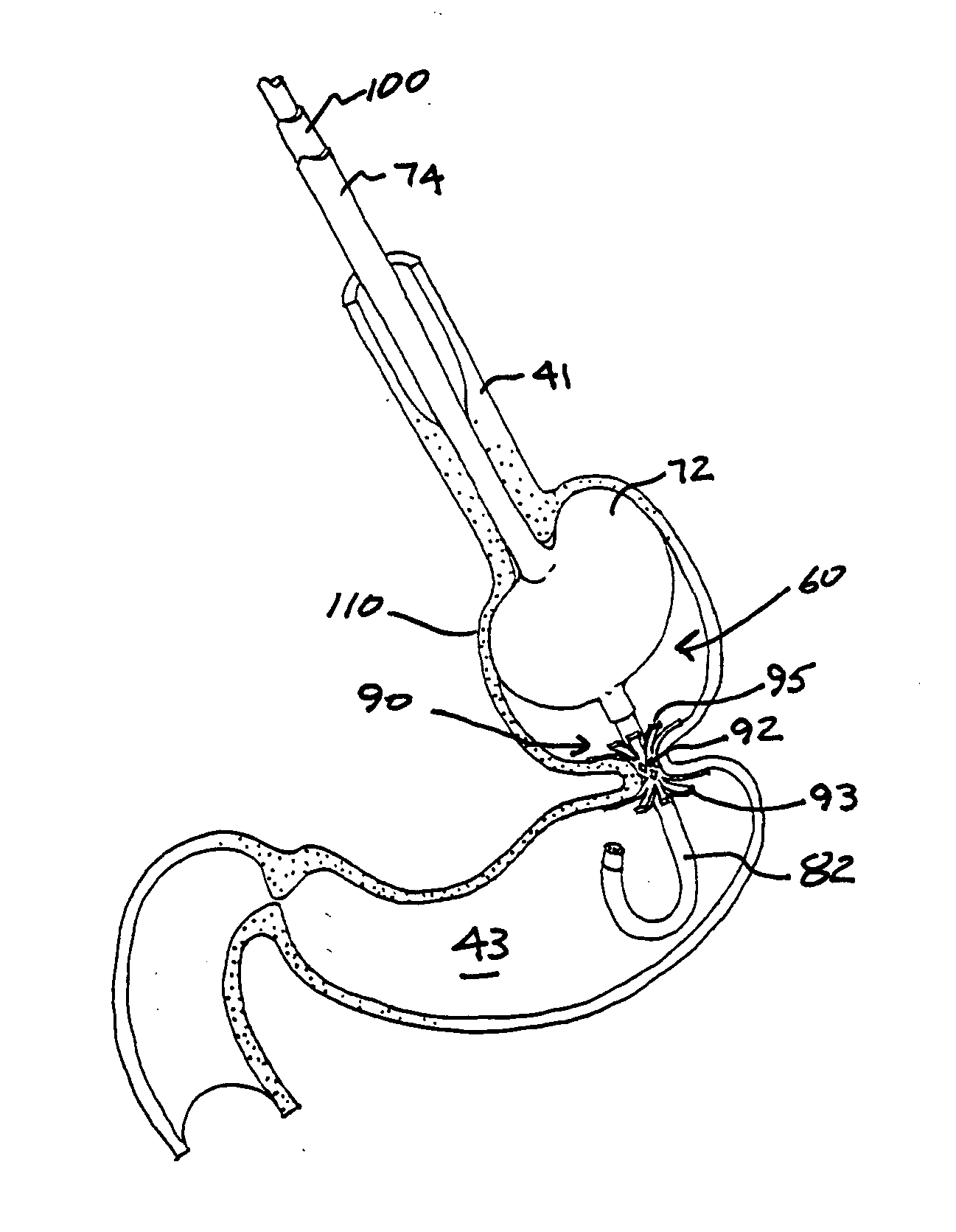 Transesophageal gastric reduction device, system and method