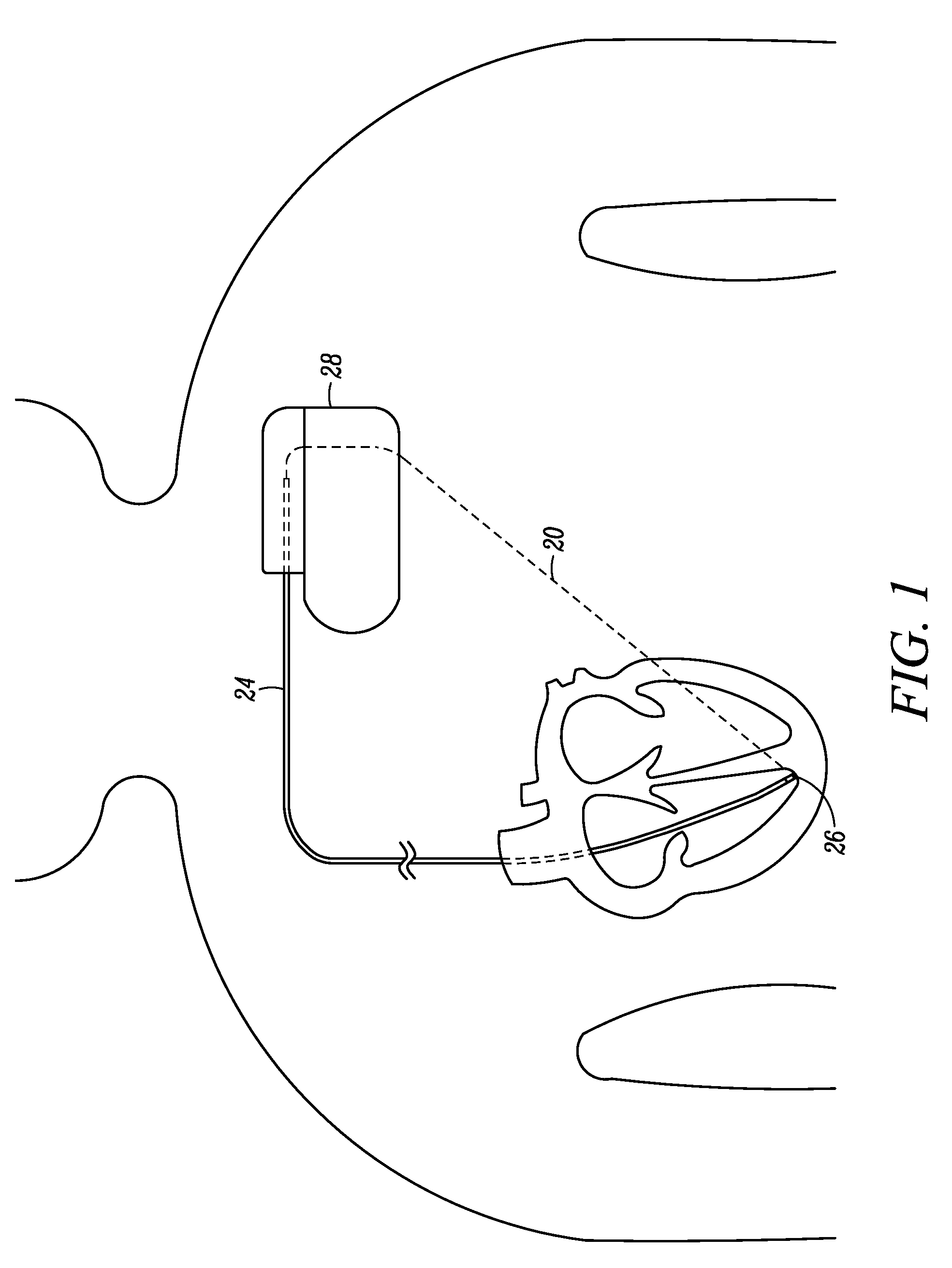 MRI Compatible Implantable Medical Devices and Methods