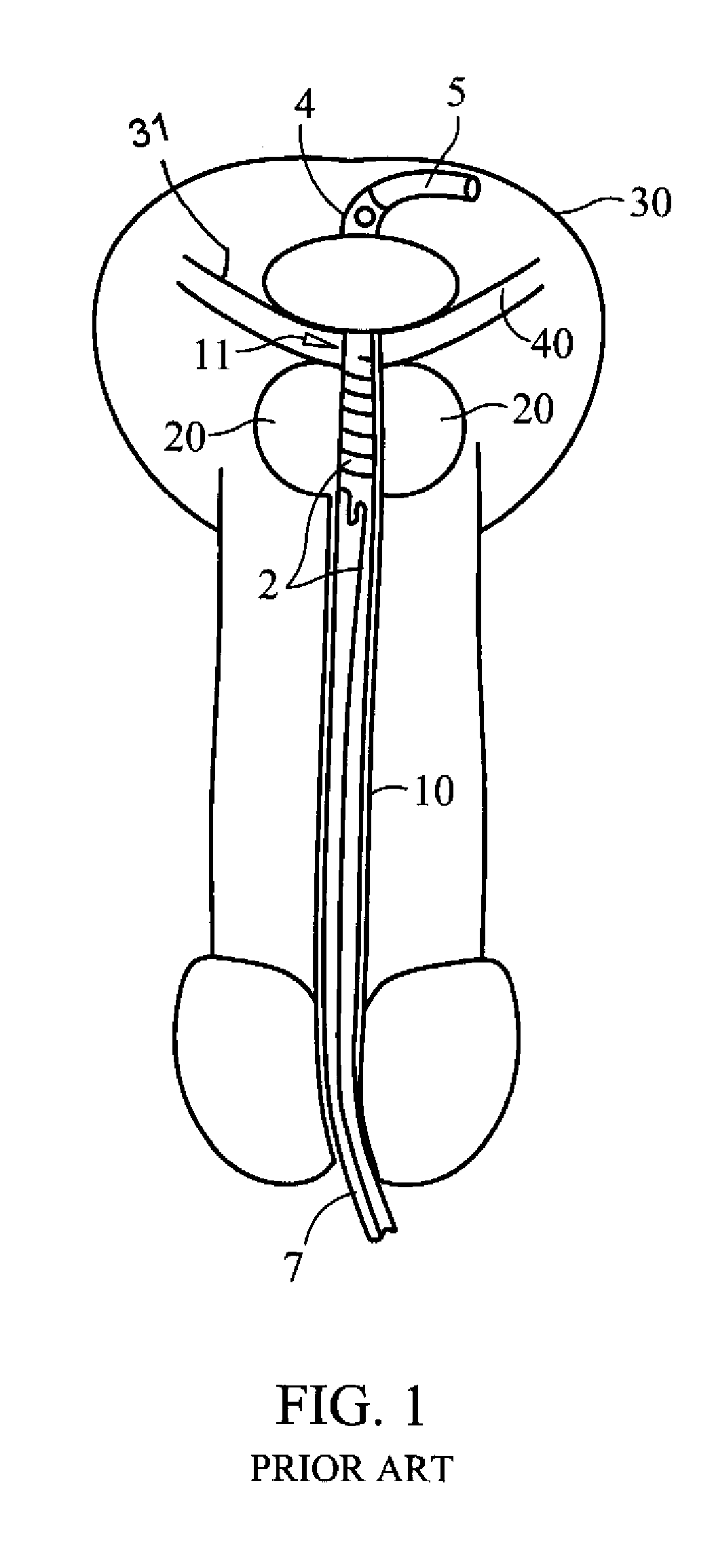 Illuminating balloon catheter and method for using the catheter