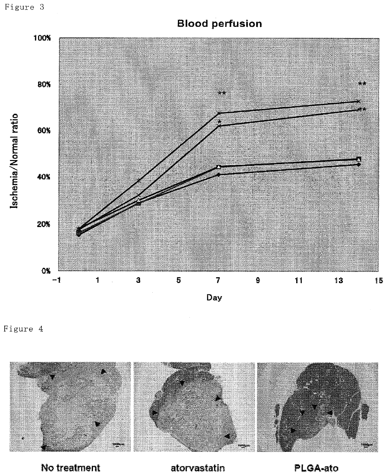 Pharmaceutical composition containing statin-encapsulated nanoparticle