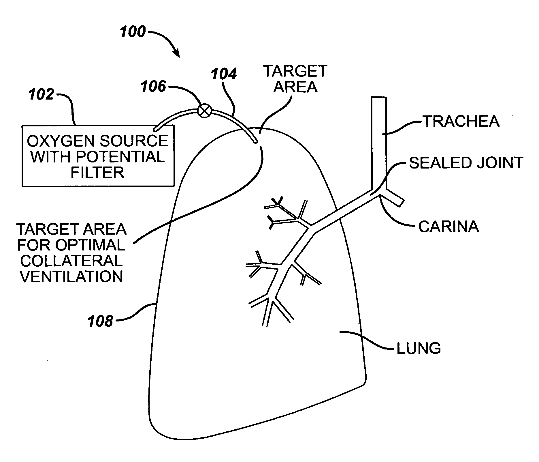 Lung reduction system