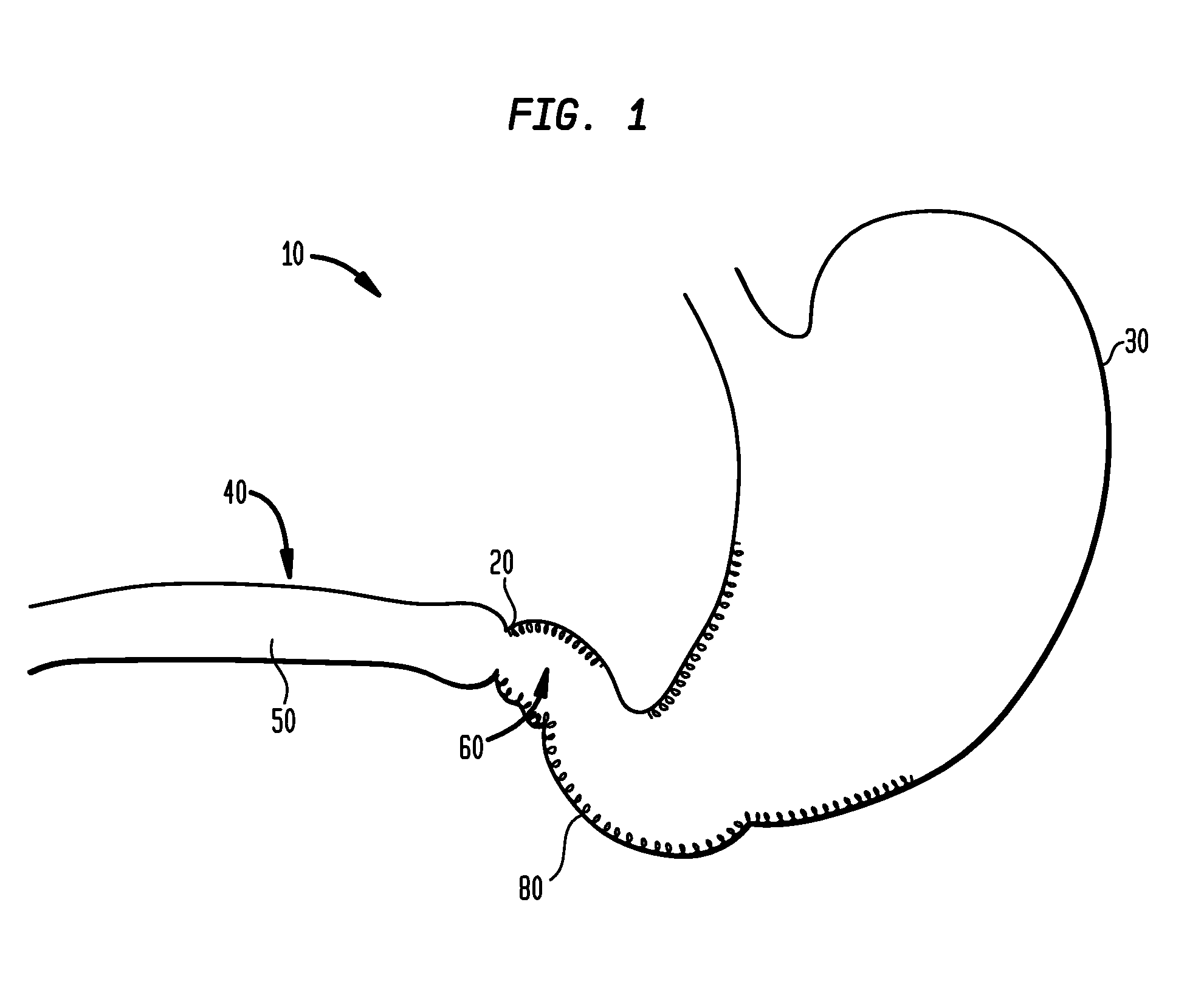Systems and Methods for Treating of Obesity and Type 2 Diabetes