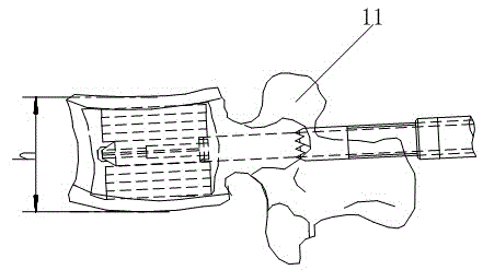 A superimposed full-height vertebroplasty