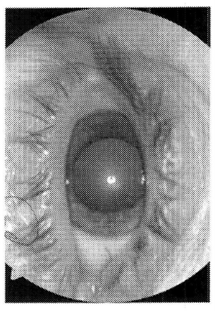 Composition and method of treatment for dry a.m.d. (age related macular degeneration)