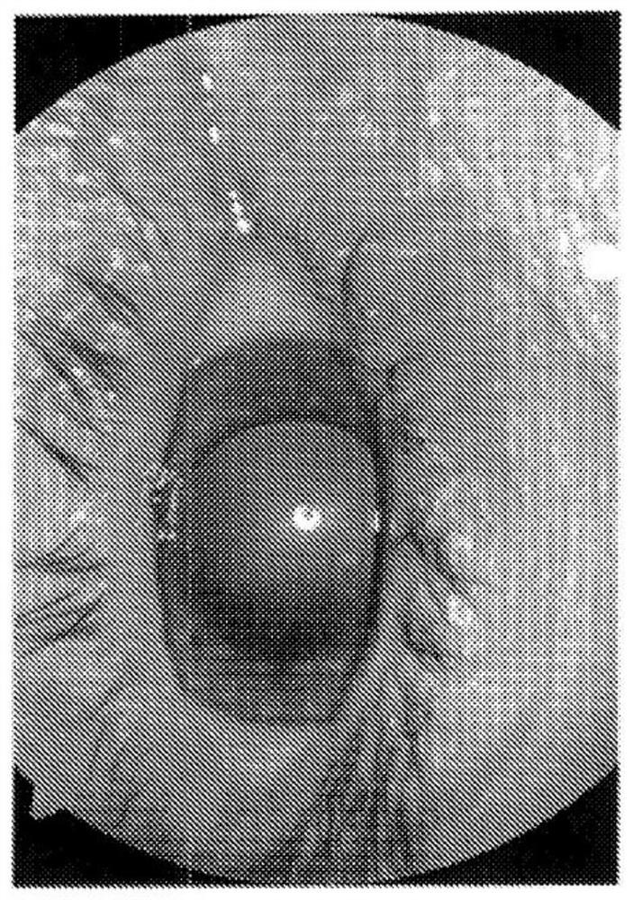 Composition and method of treatment for dry a.m.d. (age related macular degeneration)
