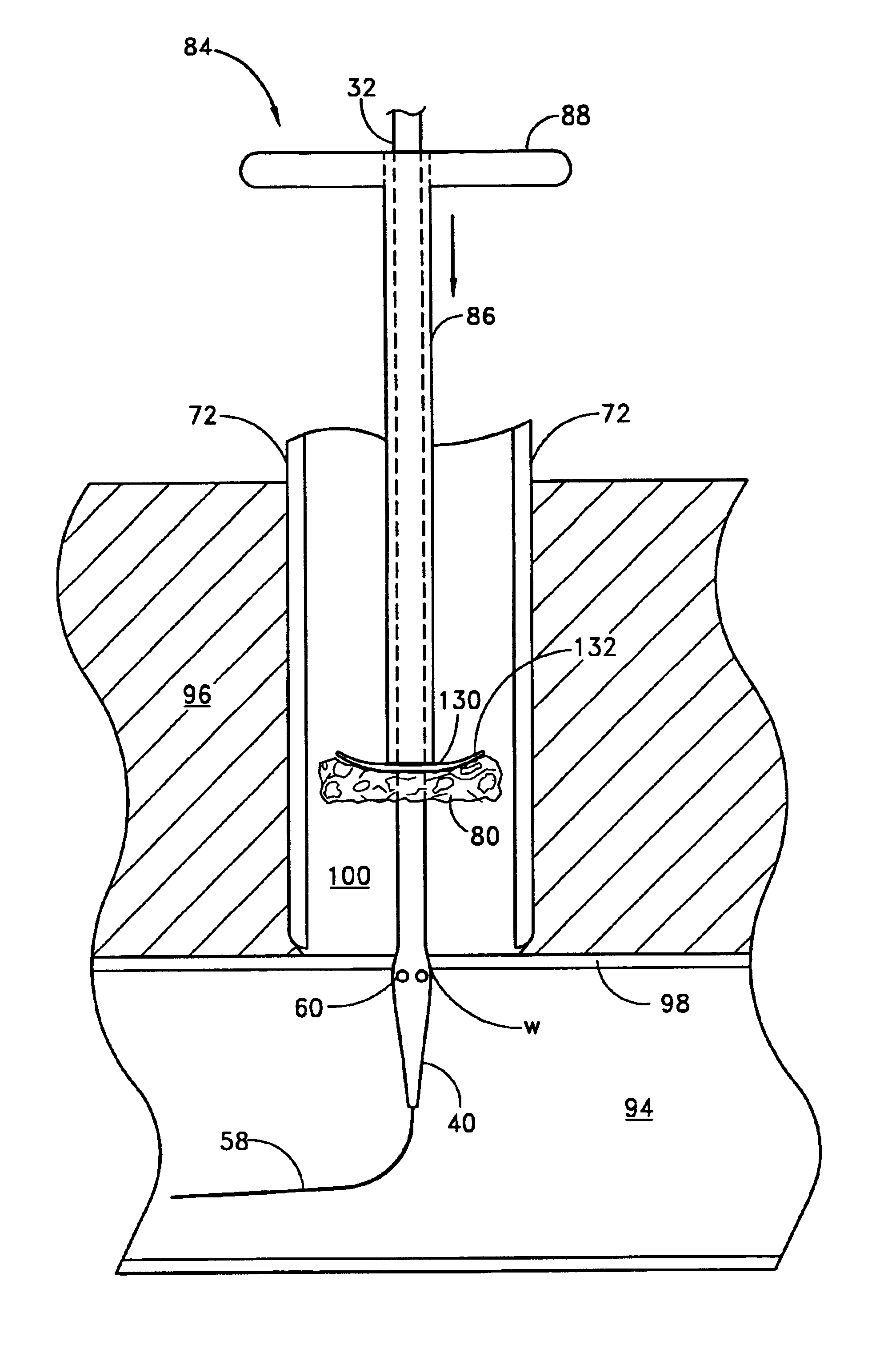 Method and apparatus for closing vascular puncture using hemostatic material