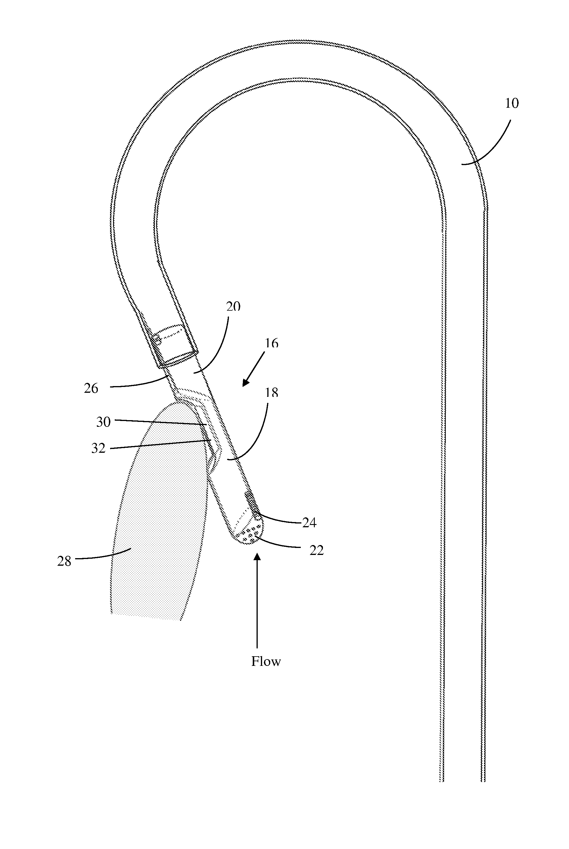 Method and device for the treatment of hypertrophic cardiomyopathy