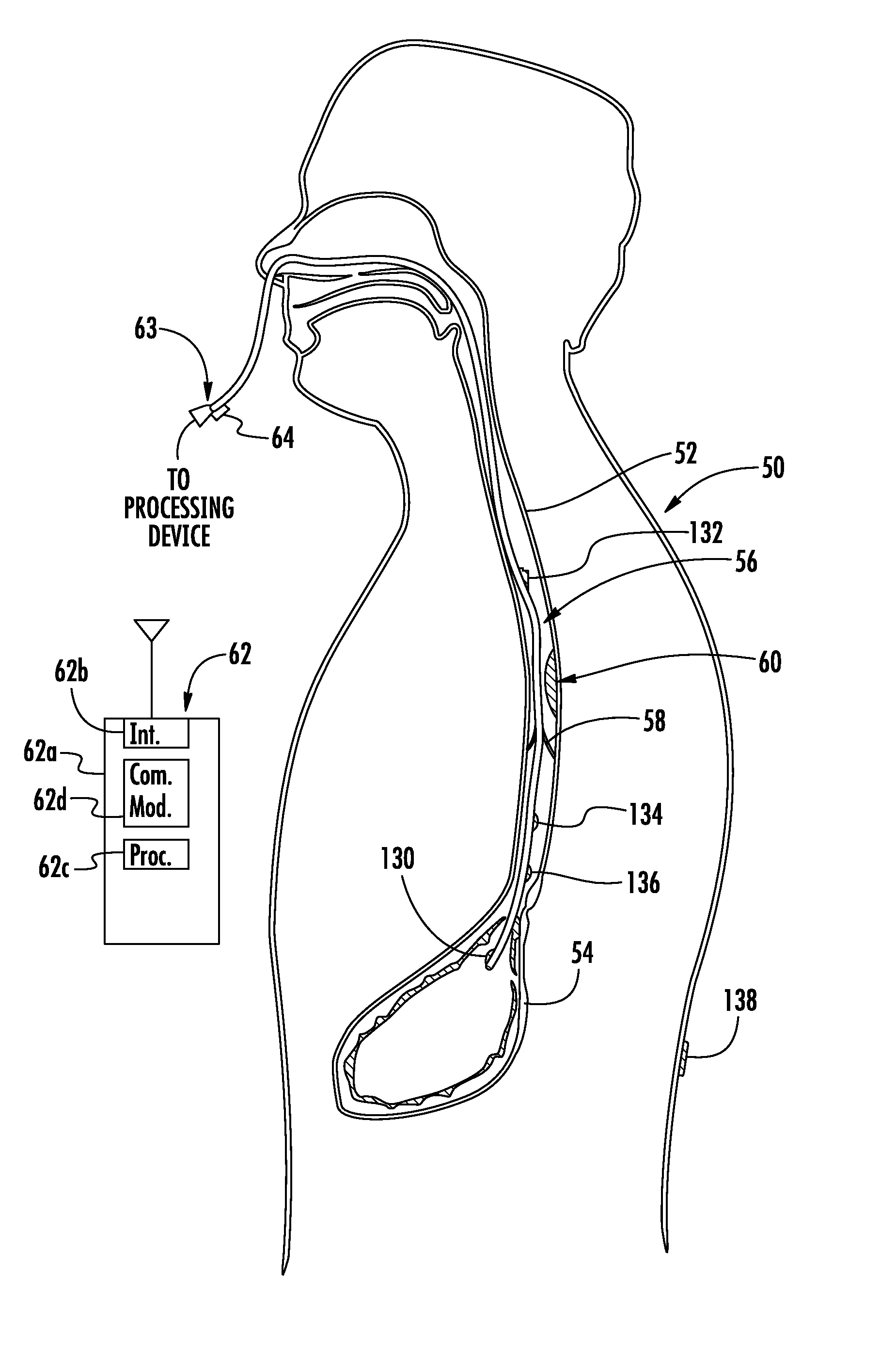 Device with passive valve to block emesis and/or reflux and associated system and method