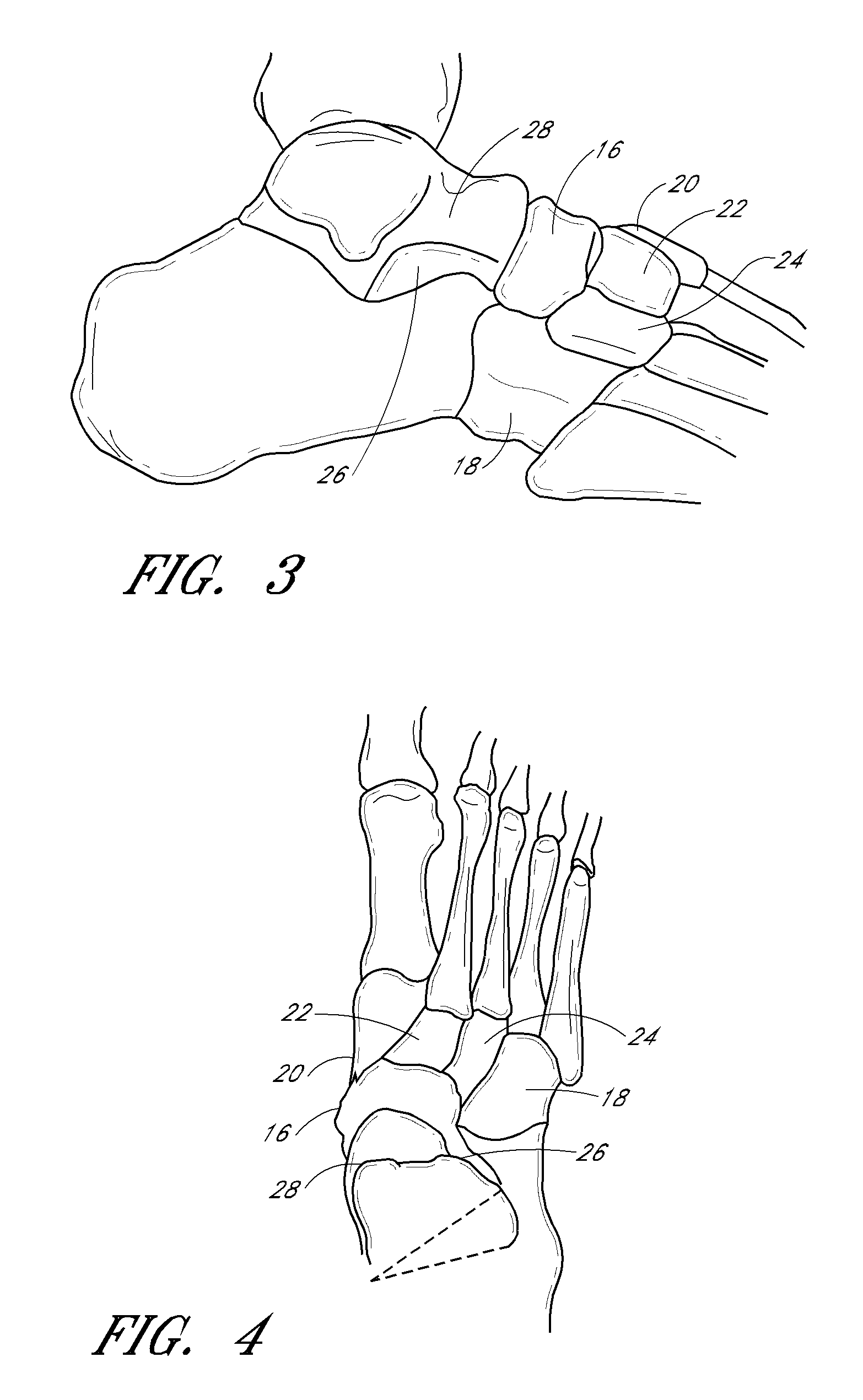 Catheter deliverable foot implant and method of delivering the same
