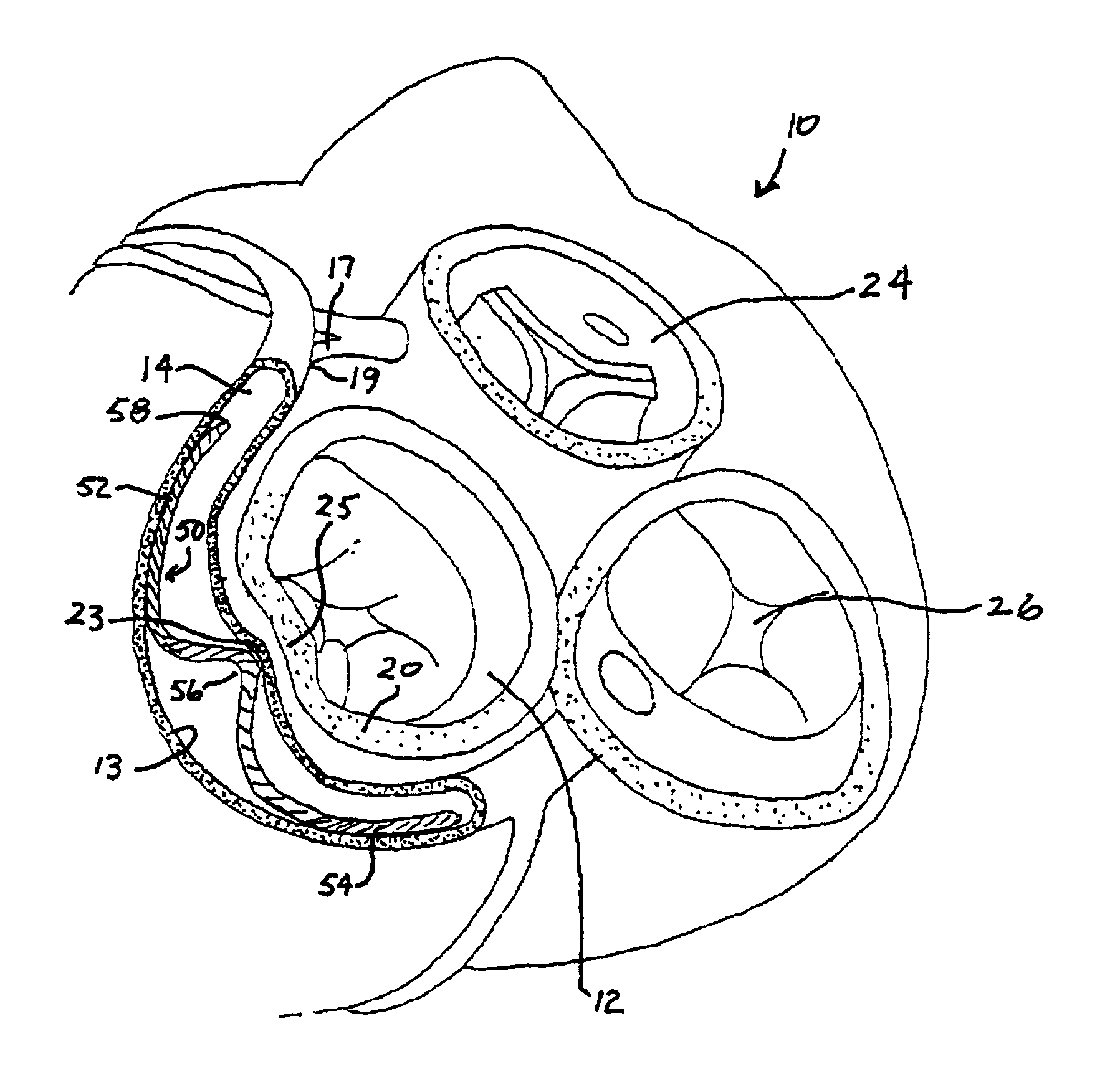 Focused compression mitral valve device and method