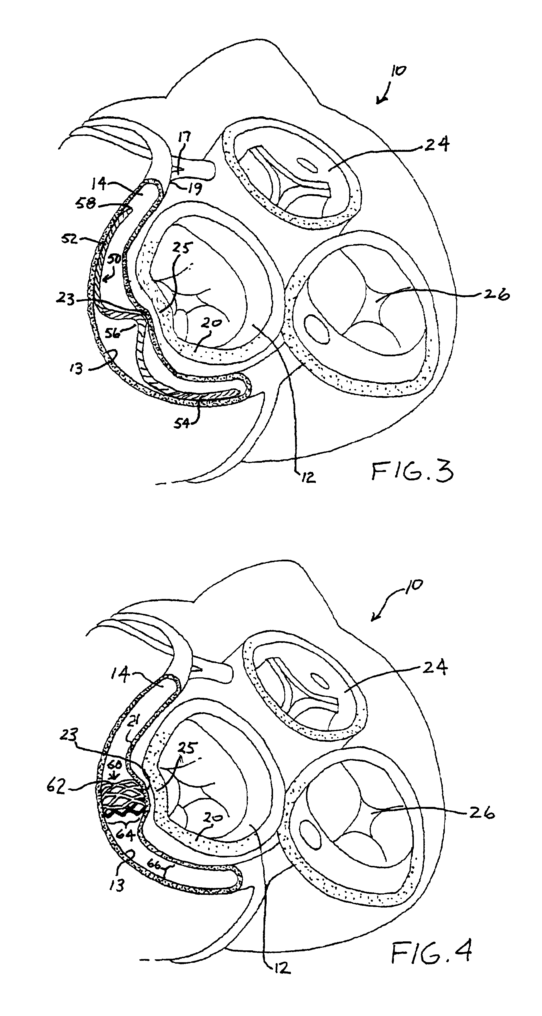 Focused compression mitral valve device and method