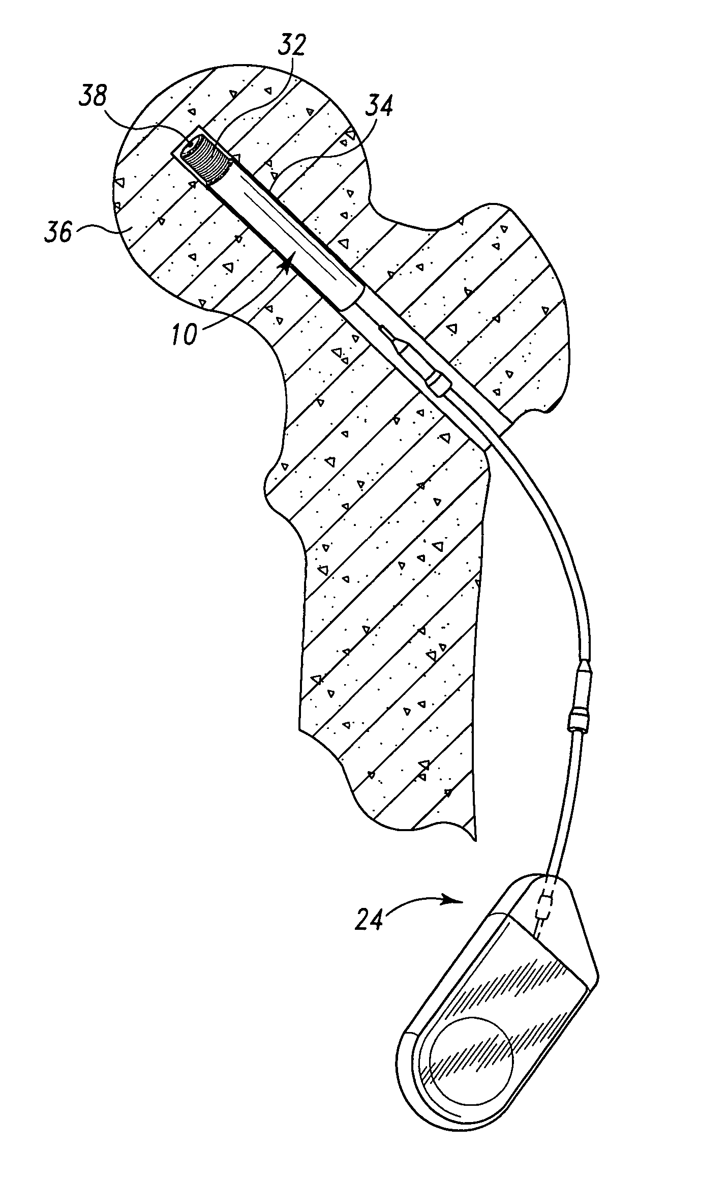 Methods and devices for treatment of osteonecrosis of the femoral head with core decompression