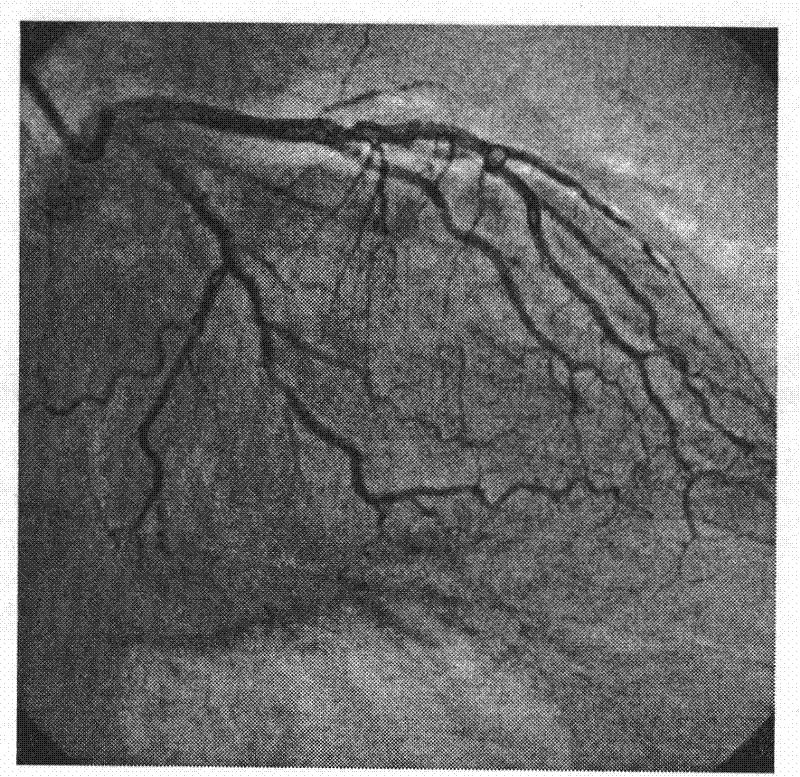 Matching method for three-dimensional coronary angiography reconstruction