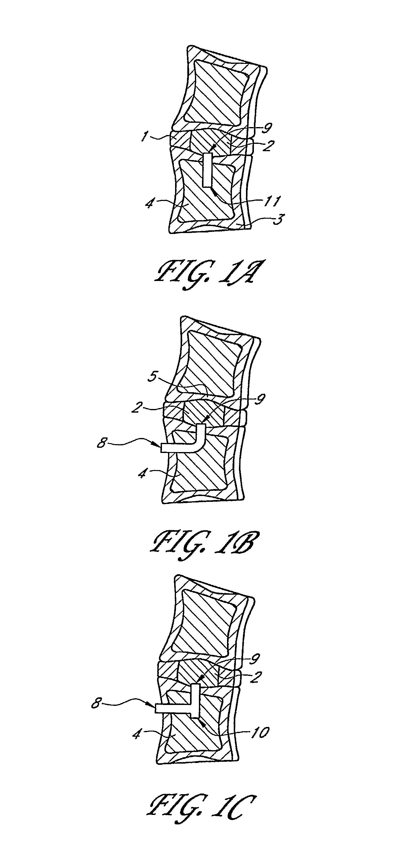 System and method for restoration of nutrient flow to nucleus pulposa