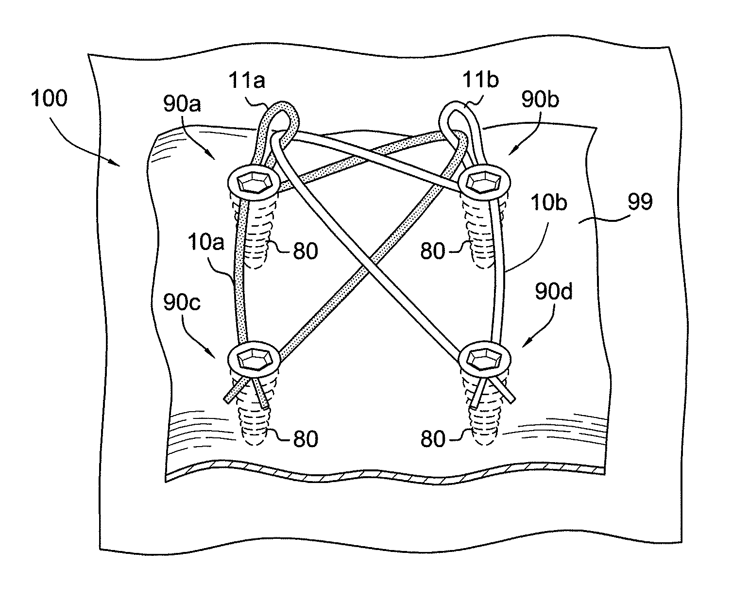 Method for creating knotless double row construct with medial row closure