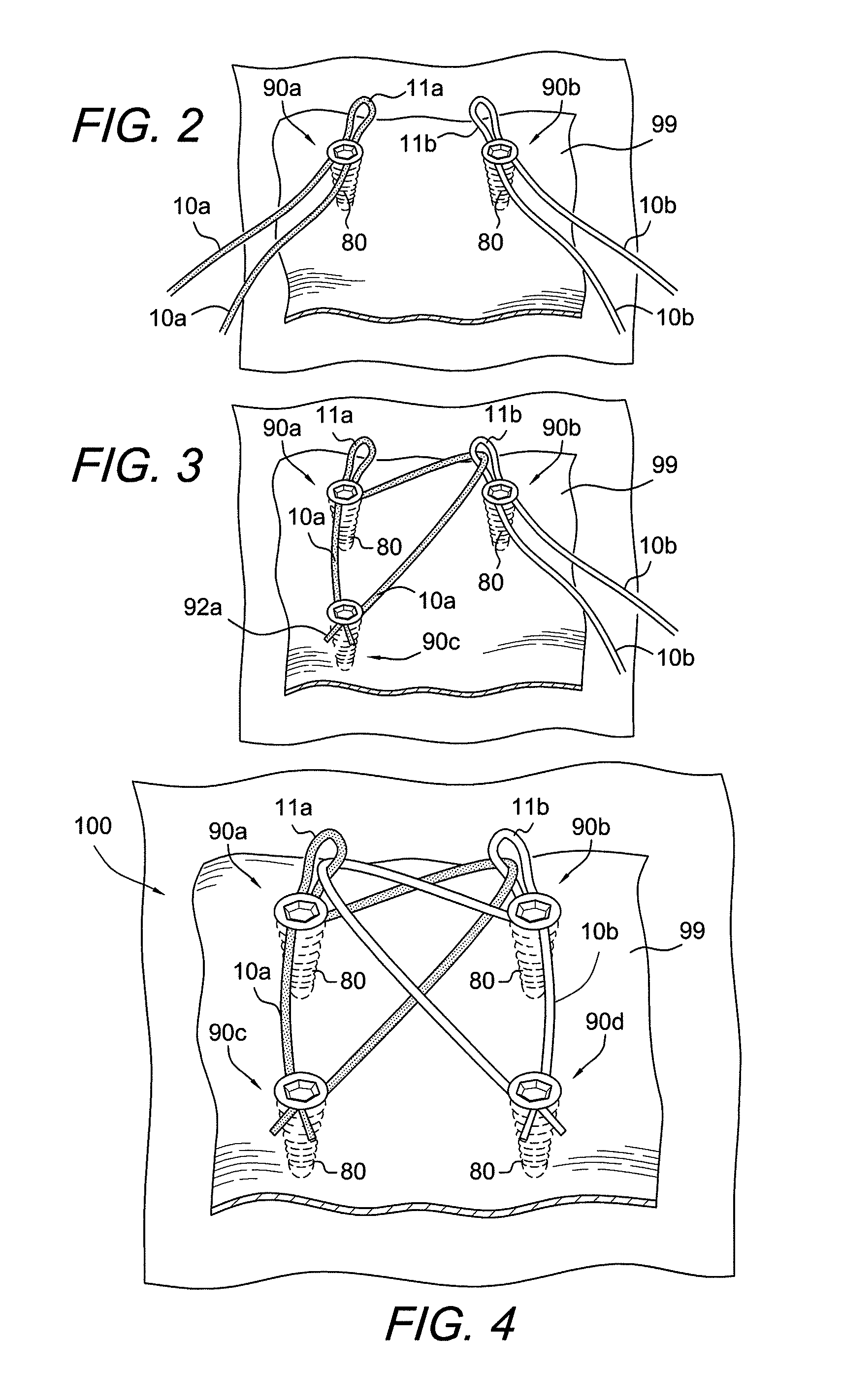 Method for creating knotless double row construct with medial row closure