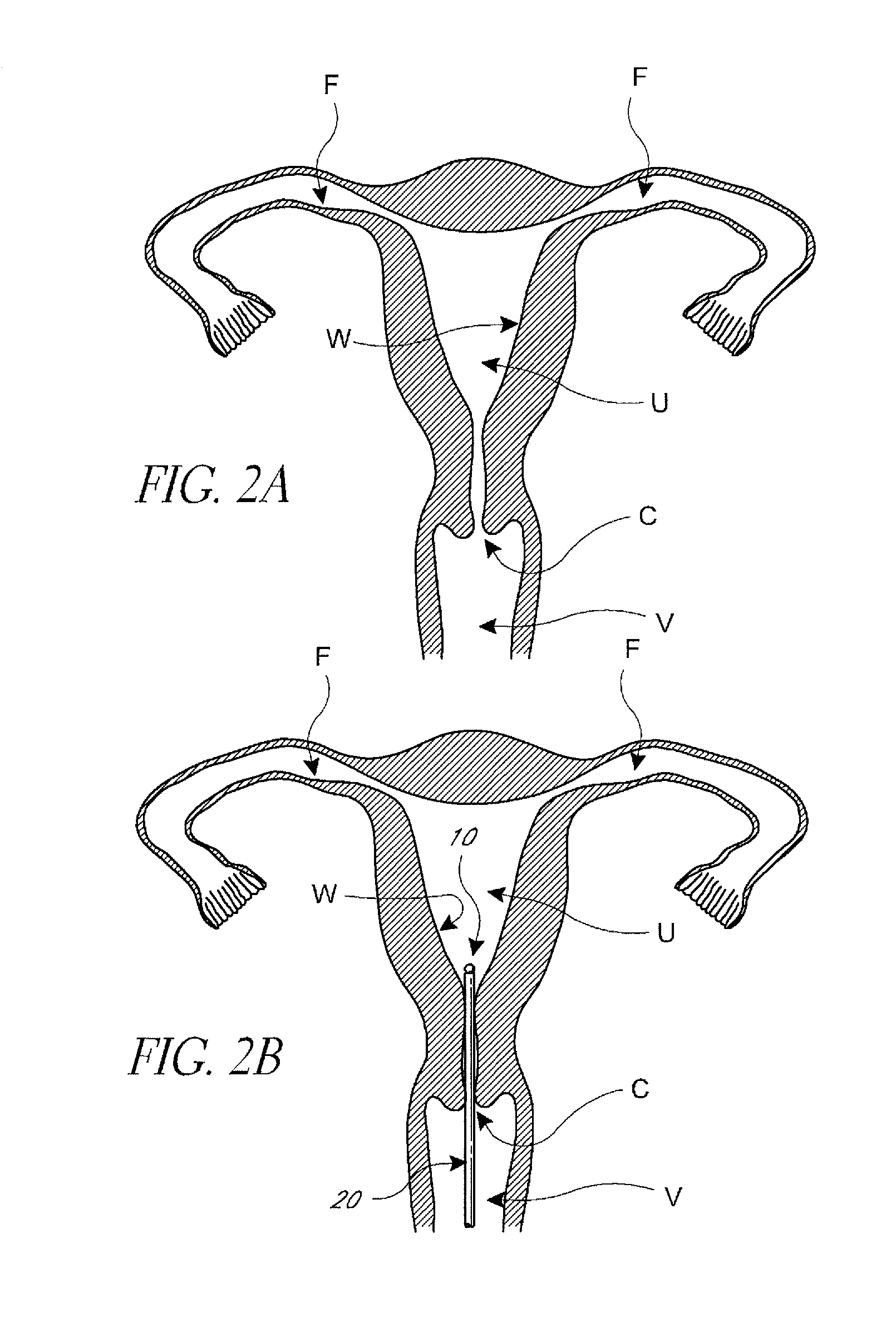 Intrauterine device