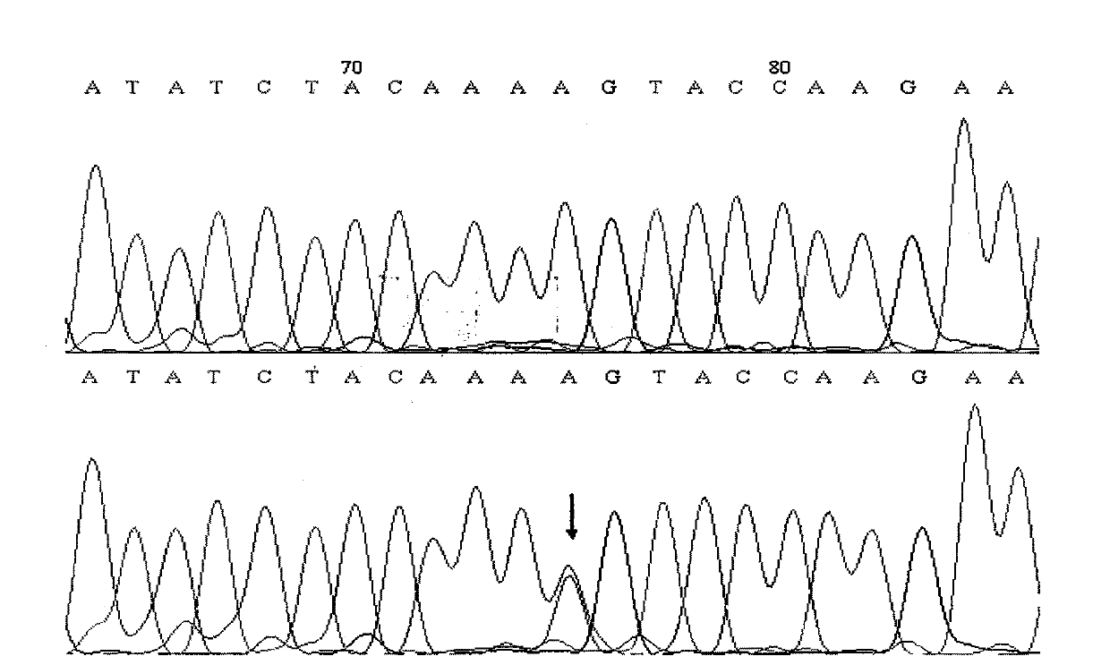 Reagent case for detecting 1594A &gt;C mutation of large vestibular aqueduct related gene SLC26A4