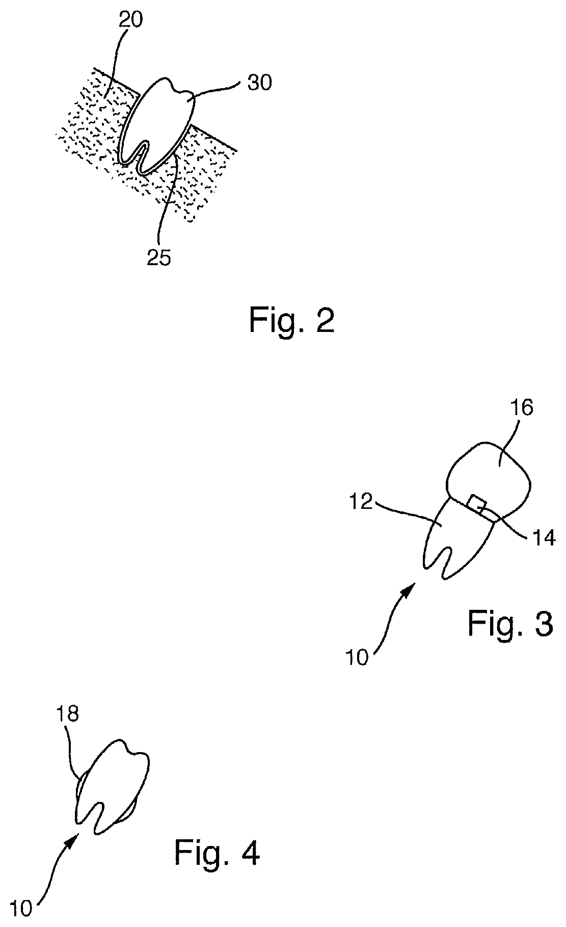 Method for producing an anatomical dental implant