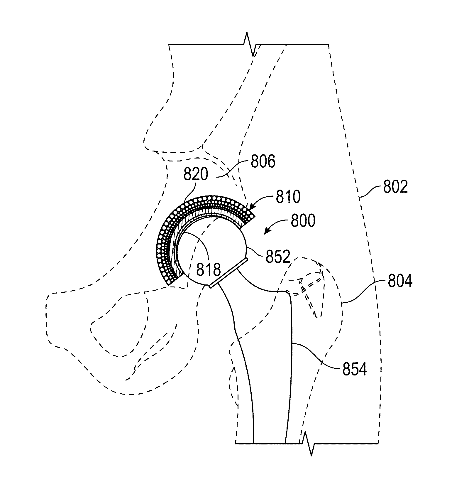 Joint Replacement or Joint Resurfacing Devices, Systems and Methods
